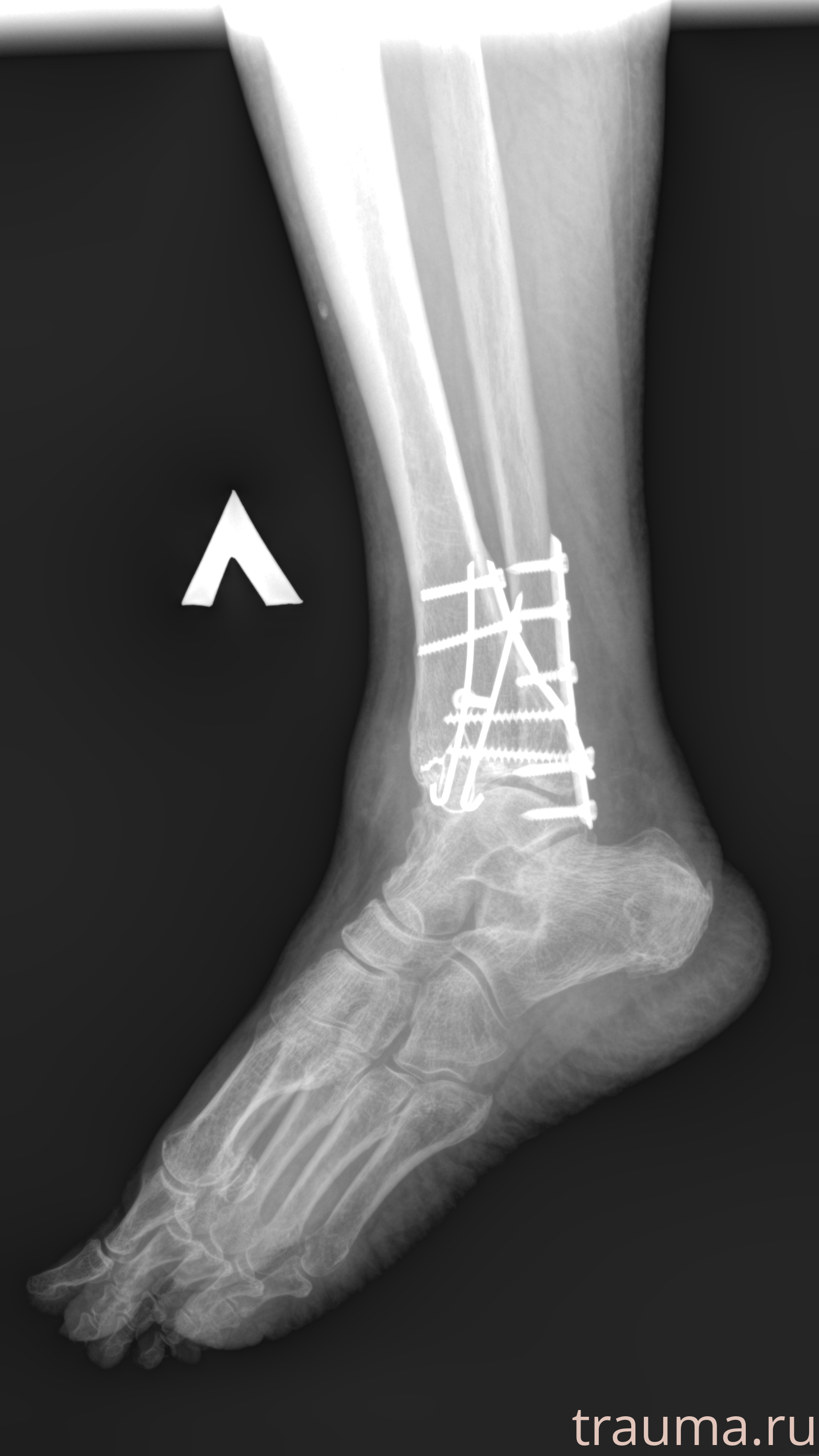 Рентген на дому: по вашему адресу приезжает врач-рентгенолог, травматолог-ортопед с мобильным рентгеновским аппаратом, проводит диагностику травмы или заболевания, делает необходимые рентгенограммы, дает рекомендации по дальнейшему лечению. Получить качественные снимки в домашних условиях возможно благодаря уникальной методике, разработанной МосРентген Центром для института  Склифосовского