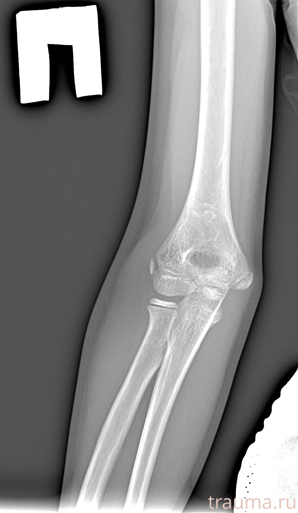 Рентген на дому: по вашему адресу приезжает врач-рентгенолог, травматолог-ортопед с мобильным рентгеновским аппаратом, проводит диагностику травмы или заболевания, делает необходимые рентгенограммы, дает рекомендации по дальнейшему лечению. Получить качественные снимки в домашних условиях возможно благодаря уникальной методике, разработанной МосРентген Центром для института  Склифосовского