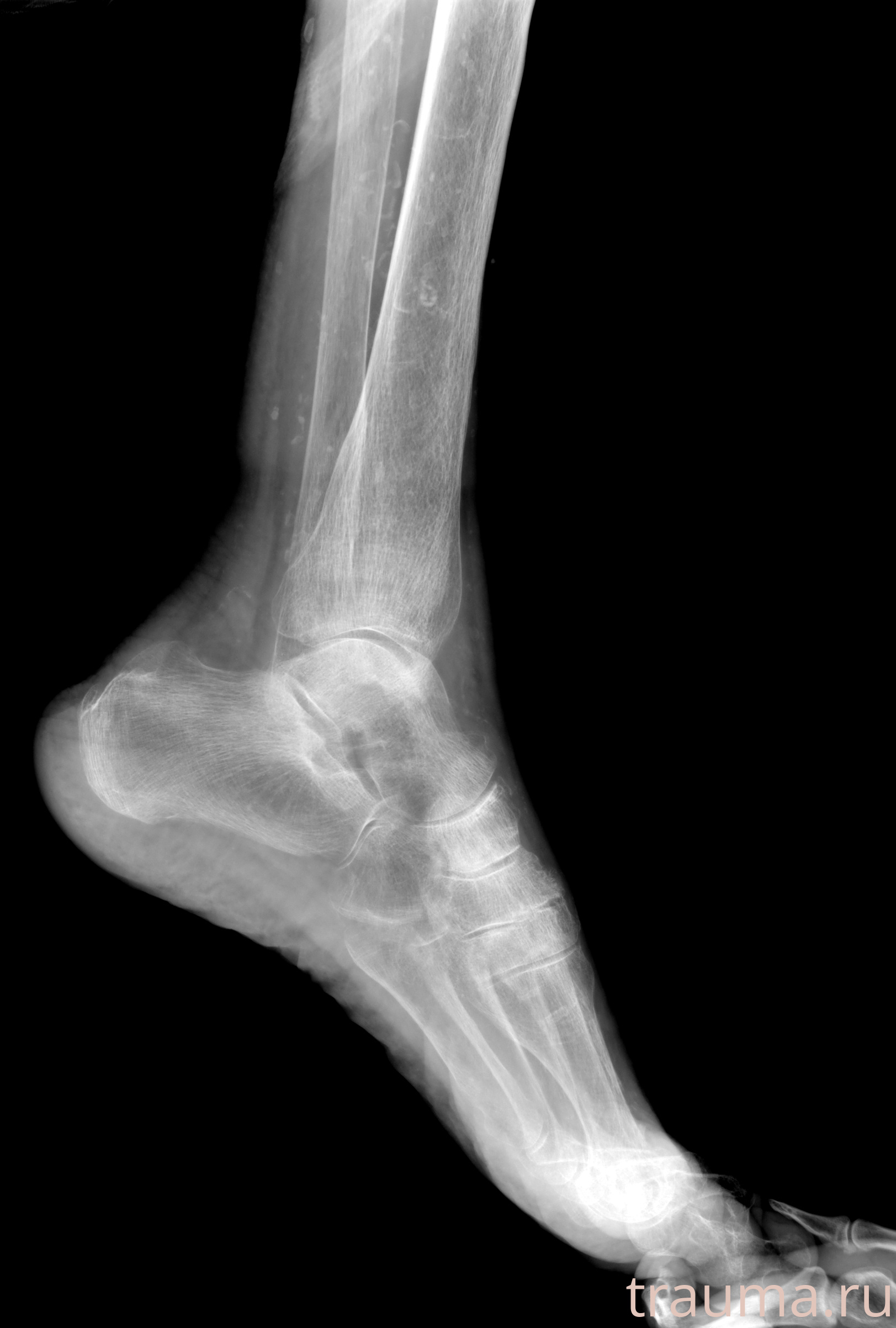 Рентген на дому: по вашему адресу приезжает врач-рентгенолог, травматолог-ортопед с мобильным рентгеновским аппаратом, проводит диагностику травмы или заболевания, делает необходимые рентгенограммы, дает рекомендации по дальнейшему лечению. Получить качественные снимки в домашних условиях возможно благодаря уникальной методике, разработанной МосРентген Центром для института  Склифосовского