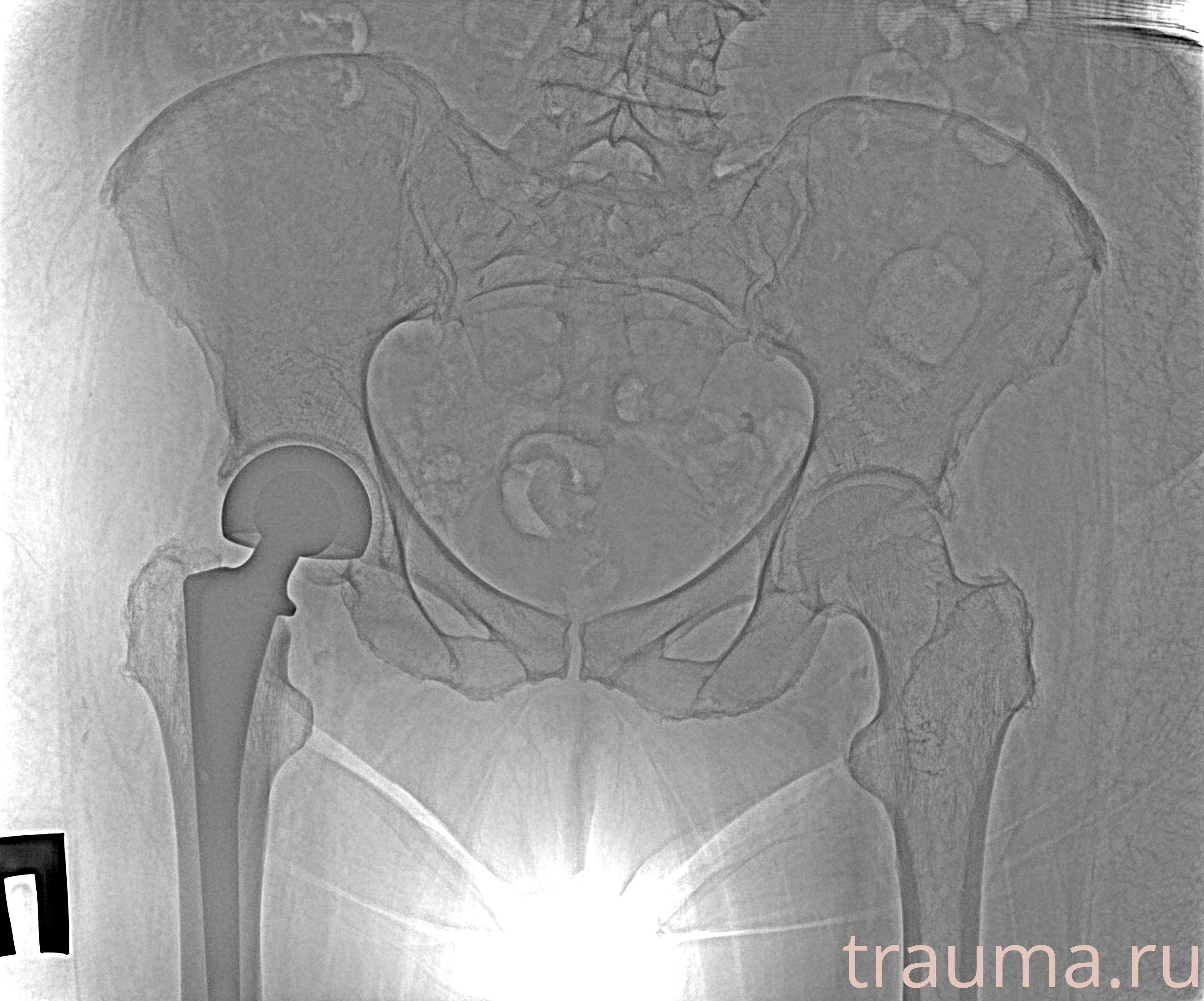 Рентген на дому: по вашему адресу приезжает врач-рентгенолог, травматолог-ортопед с мобильным рентгеновским аппаратом, проводит диагностику травмы или заболевания, делает необходимые рентгенограммы, дает рекомендации по дальнейшему лечению. Получить качественные снимки в домашних условиях возможно благодаря уникальной методике, разработанной МосРентген Центром для института  Склифосовского