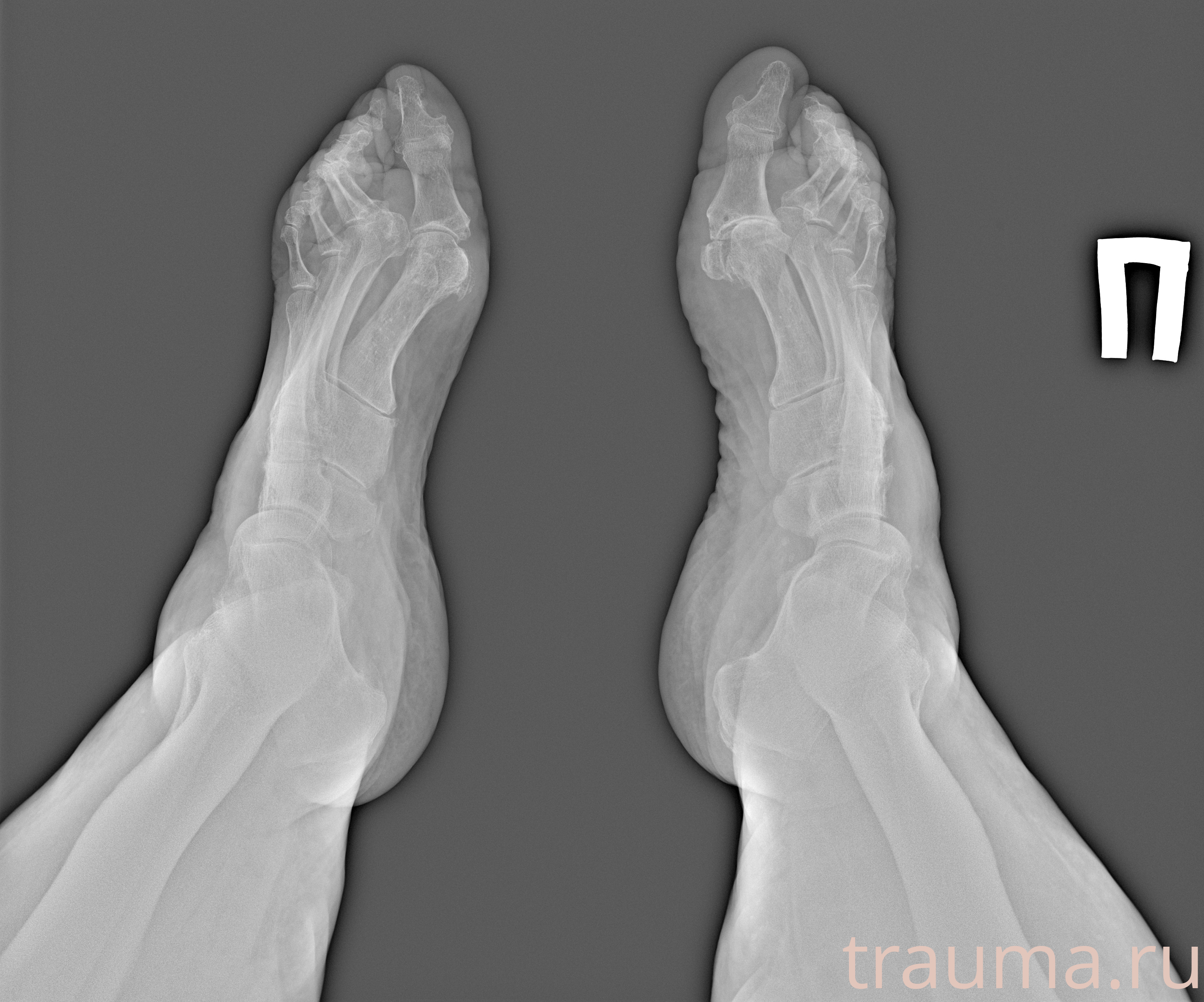 Рентген на дому: по вашему адресу приезжает врач-рентгенолог, травматолог-ортопед с мобильным рентгеновским аппаратом, проводит диагностику травмы или заболевания, делает необходимые рентгенограммы, дает рекомендации по дальнейшему лечению. Получить качественные снимки в домашних условиях возможно благодаря уникальной методике, разработанной МосРентген Центром для института  Склифосовского