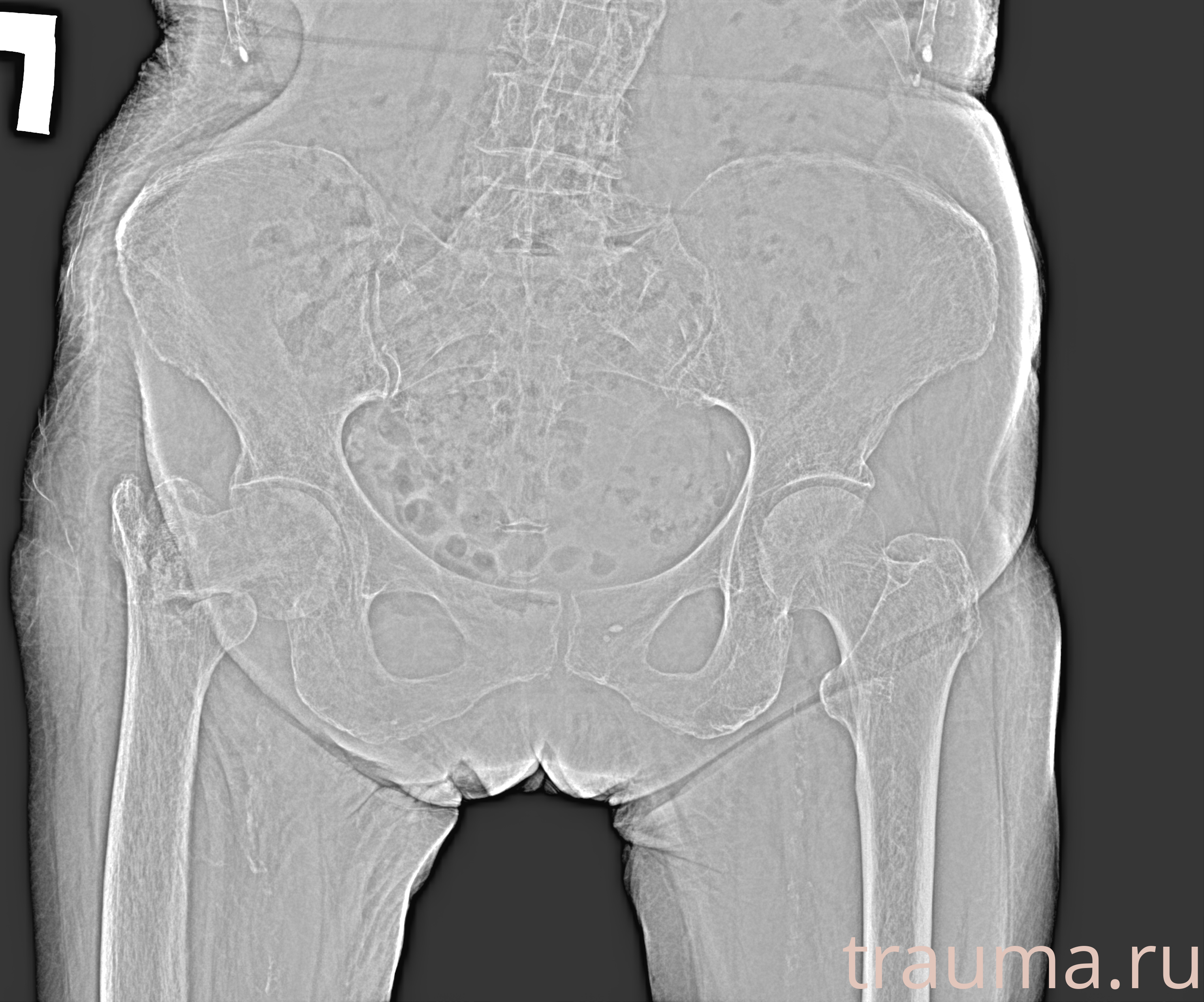 Рентген на дому: по вашему адресу приезжает врач-рентгенолог, травматолог-ортопед с мобильным рентгеновским аппаратом, проводит диагностику травмы или заболевания, делает необходимые рентгенограммы, дает рекомендации по дальнейшему лечению. Получить качественные снимки в домашних условиях возможно благодаря уникальной методике, разработанной МосРентген Центром для института  Склифосовского