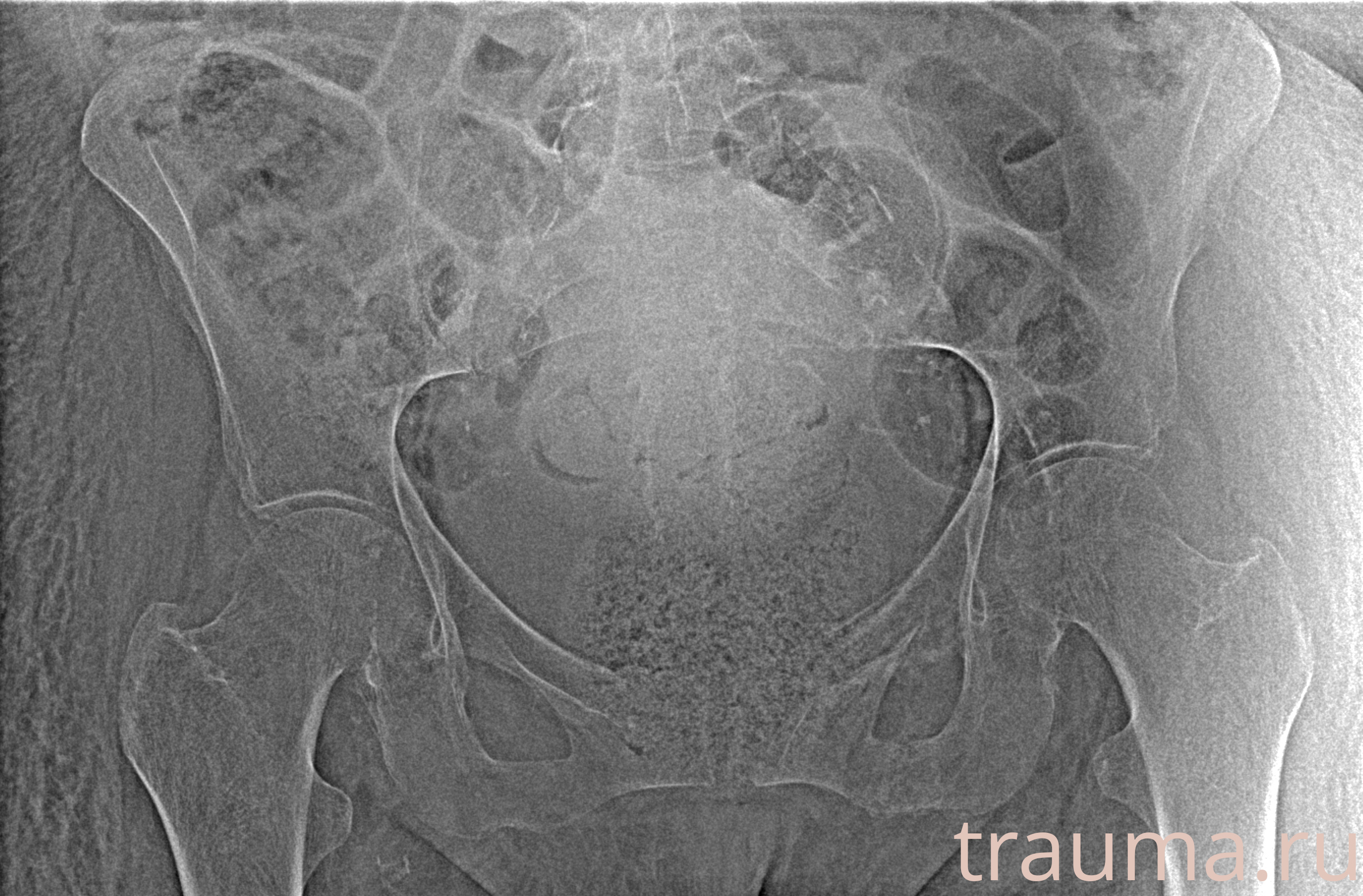 Рентген на дому: по вашему адресу приезжает врач-рентгенолог, травматолог-ортопед с мобильным рентгеновским аппаратом, проводит диагностику травмы или заболевания, делает необходимые рентгенограммы, дает рекомендации по дальнейшему лечению. Получить качественные снимки в домашних условиях возможно благодаря уникальной методике, разработанной МосРентген Центром для института  Склифосовского