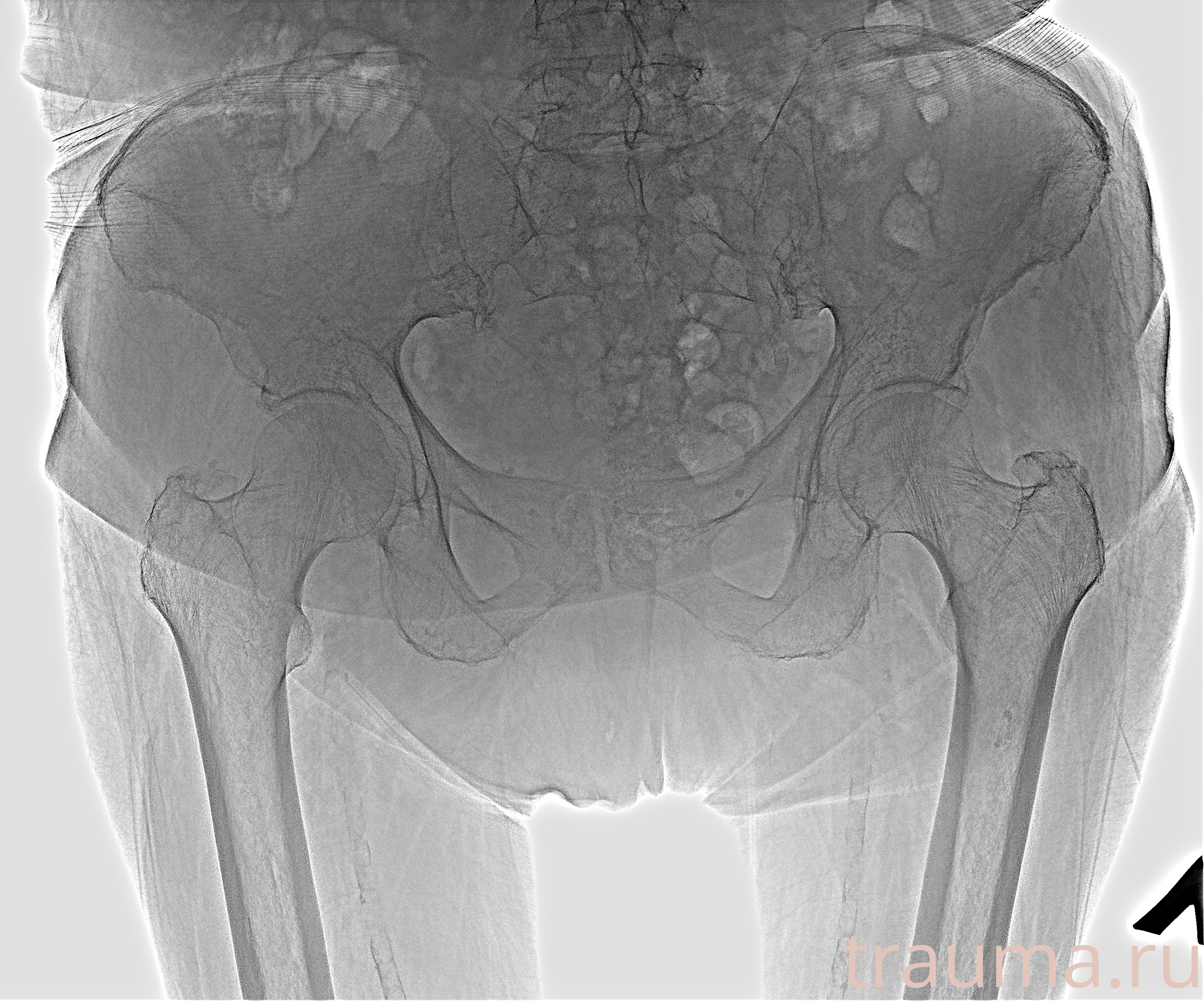 Рентген на дому: по вашему адресу приезжает врач-рентгенолог, травматолог-ортопед с мобильным рентгеновским аппаратом, проводит диагностику травмы или заболевания, делает необходимые рентгенограммы, дает рекомендации по дальнейшему лечению. Получить качественные снимки в домашних условиях возможно благодаря уникальной методике, разработанной МосРентген Центром для института  Склифосовского