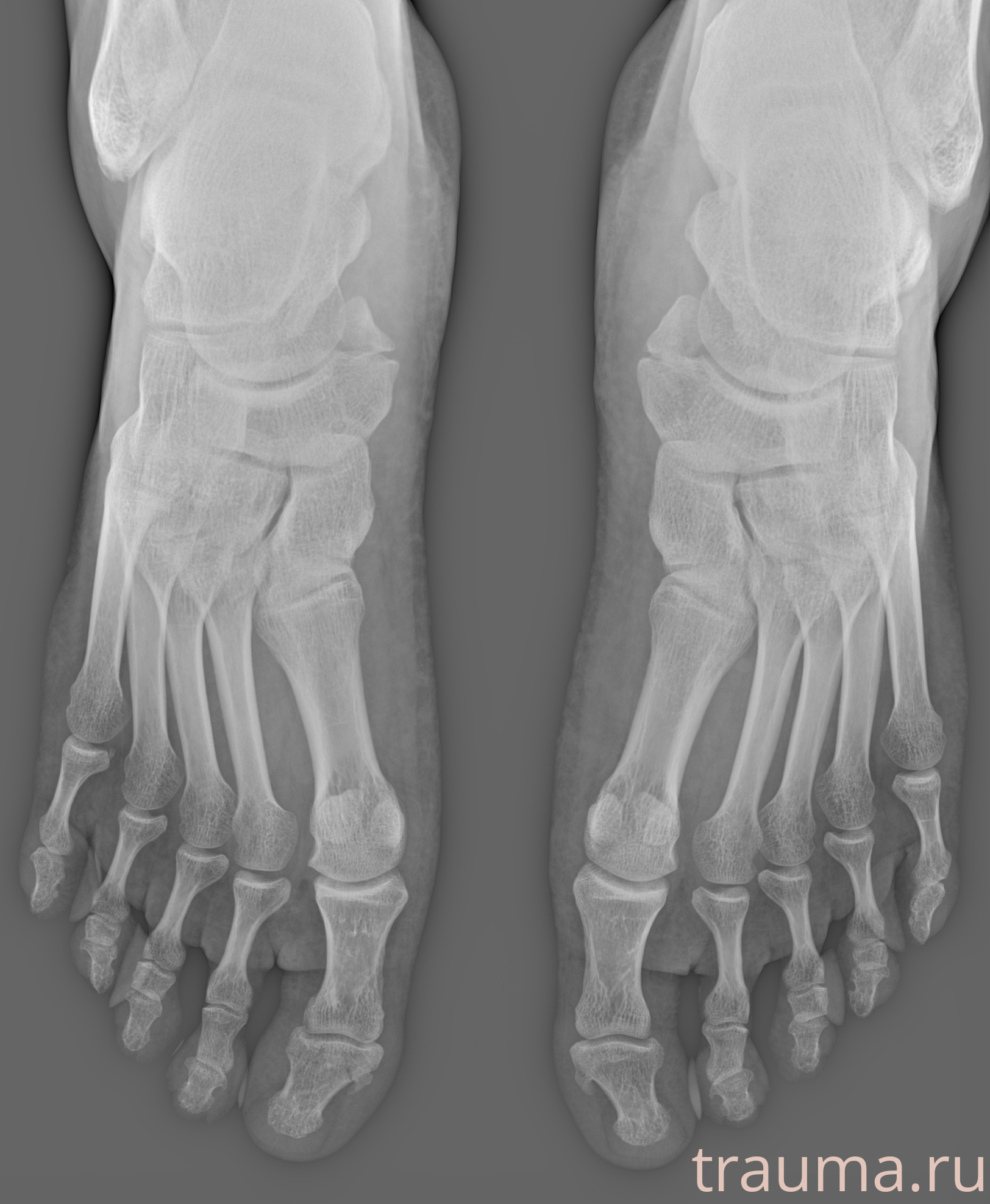 Рентген на дому: по вашему адресу приезжает врач-рентгенолог, травматолог-ортопед с мобильным рентгеновским аппаратом, проводит диагностику травмы или заболевания, делает необходимые рентгенограммы, дает рекомендации по дальнейшему лечению. Получить качественные снимки в домашних условиях возможно благодаря уникальной методике, разработанной МосРентген Центром для института  Склифосовского