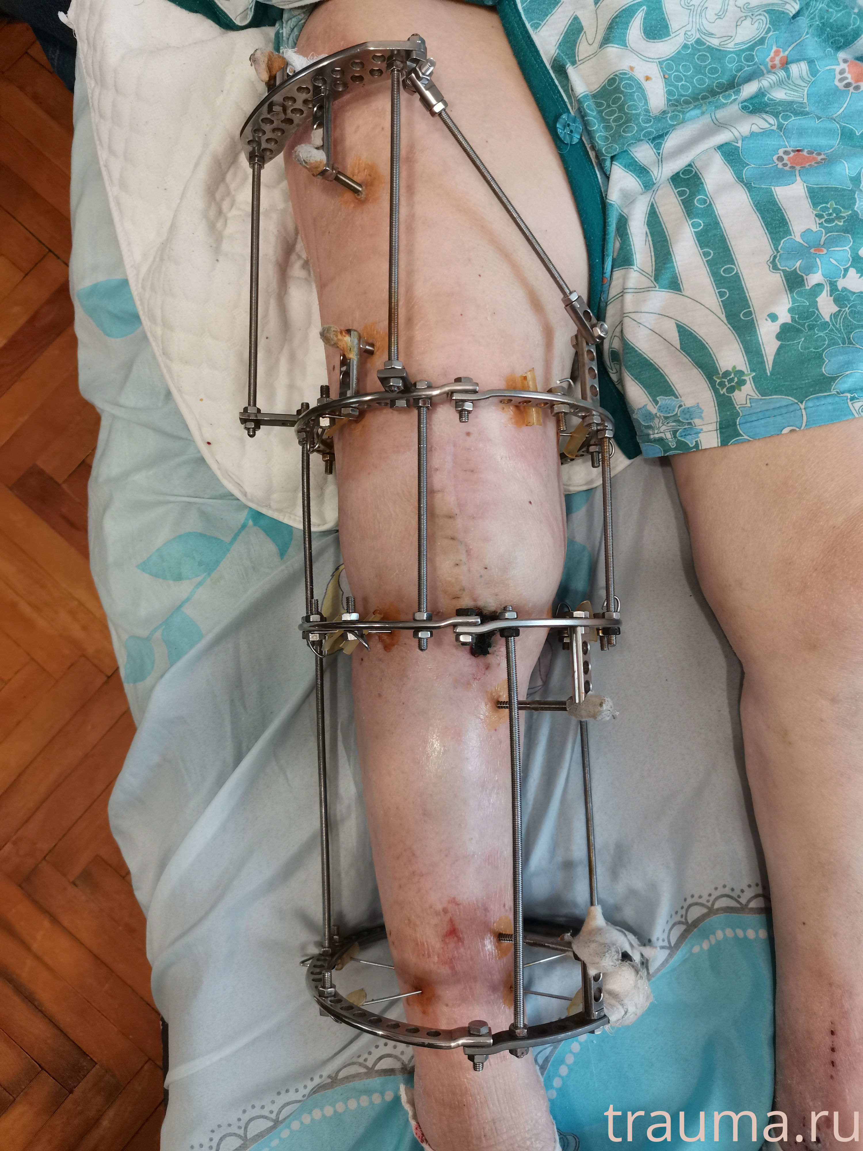 Рентген на дому: по вашему адресу приезжает врач-рентгенолог, травматолог-ортопед с мобильным рентгеновским аппаратом, проводит диагностику травмы или заболевания, делает необходимые рентгенограммы, дает рекомендации по дальнейшему лечению. Получить качественные снимки в домашних условиях возможно благодаря уникальной методике, разработанной МосРентген Центром для института  Склифосовского