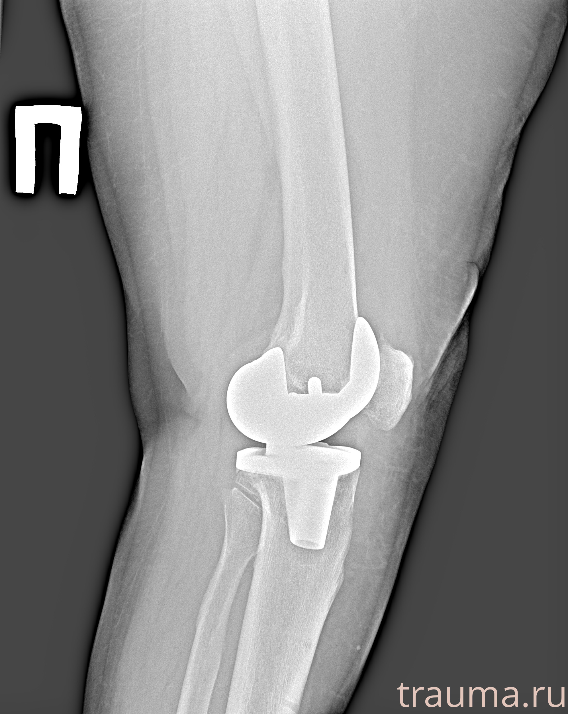 Рентген на дому: по вашему адресу приезжает врач-рентгенолог, травматолог-ортопед с мобильным рентгеновским аппаратом, проводит диагностику травмы или заболевания, делает необходимые рентгенограммы, дает рекомендации по дальнейшему лечению. Получить качественные снимки в домашних условиях возможно благодаря уникальной методике, разработанной МосРентген Центром для института  Склифосовского