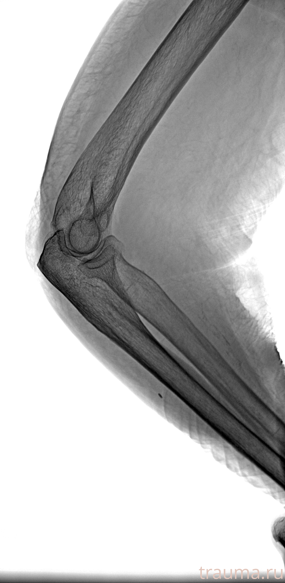 Рентген на дому: по вашему адресу приезжает врач-рентгенолог, травматолог-ортопед с мобильным рентгеновским аппаратом, проводит диагностику травмы или заболевания, делает необходимые рентгенограммы, дает рекомендации по дальнейшему лечению. Получить качественные снимки в домашних условиях возможно благодаря уникальной методике, разработанной МосРентген Центром для института  Склифосовского