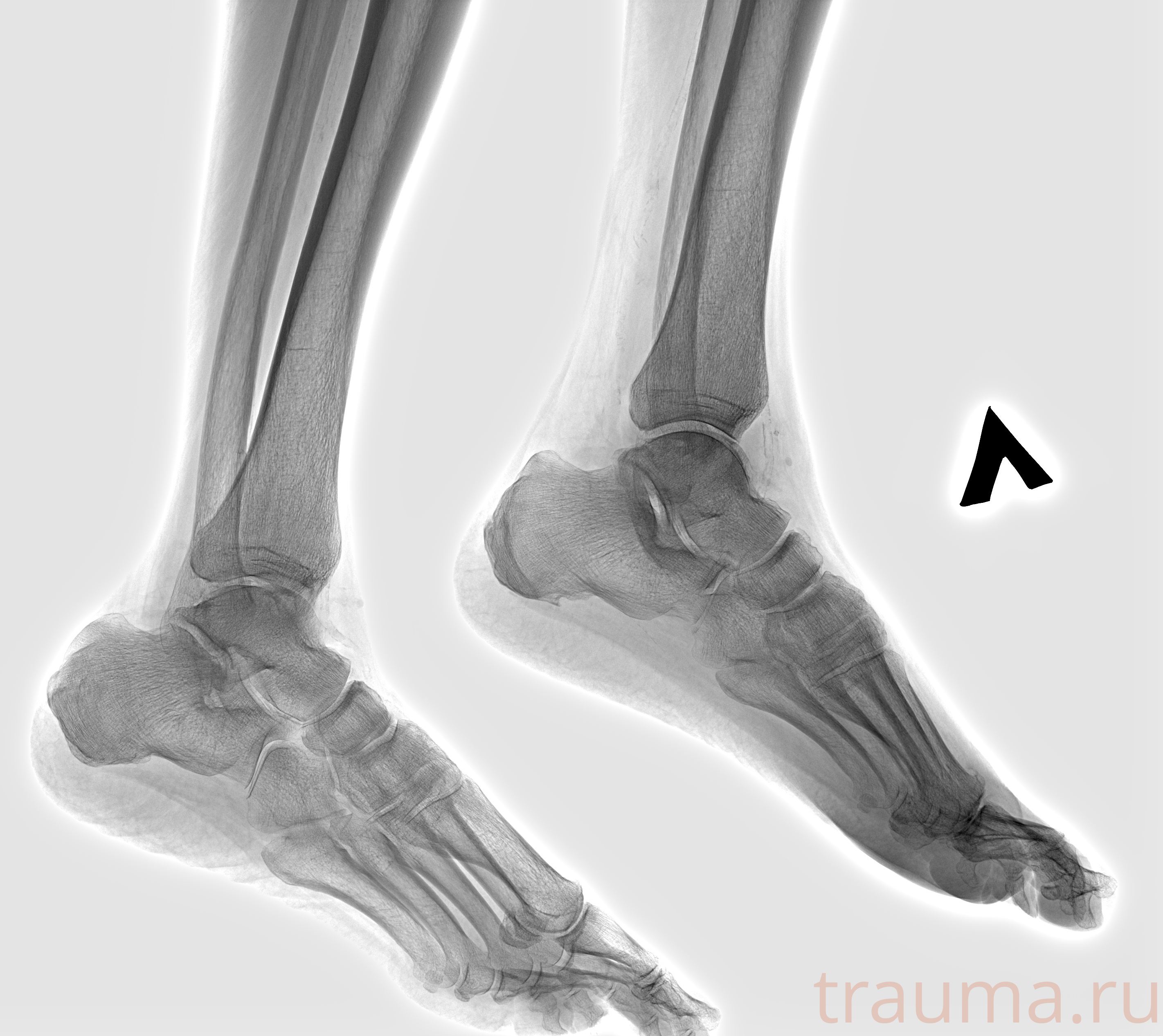 Рентген на дому: по вашему адресу приезжает врач-рентгенолог, травматолог-ортопед с мобильным рентгеновским аппаратом, проводит диагностику травмы или заболевания, делает необходимые рентгенограммы, дает рекомендации по дальнейшему лечению. Получить качественные снимки в домашних условиях возможно благодаря уникальной методике, разработанной МосРентген Центром для института  Склифосовского