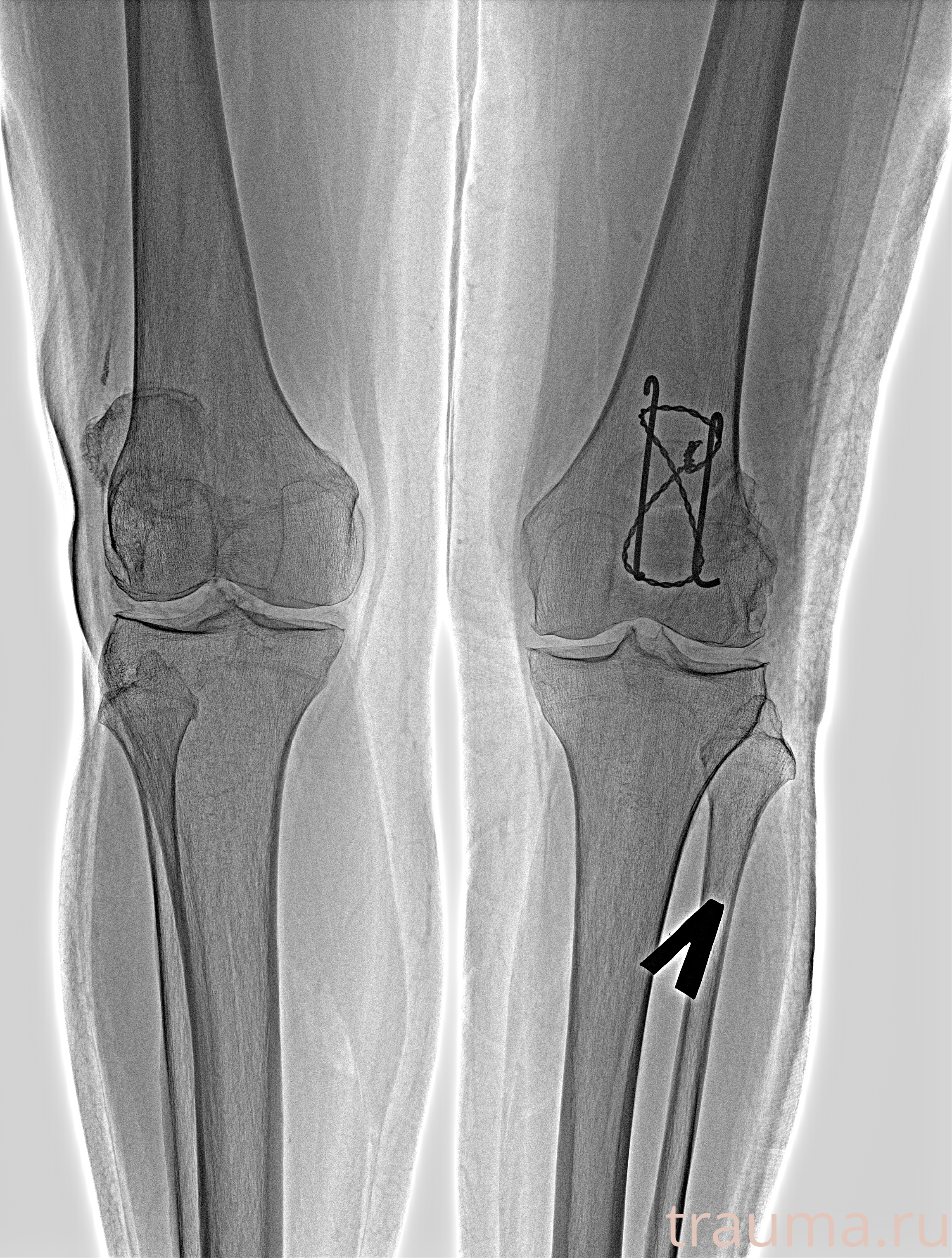 Рентген на дому: по вашему адресу приезжает врач-рентгенолог, травматолог-ортопед с мобильным рентгеновским аппаратом, проводит диагностику травмы или заболевания, делает необходимые рентгенограммы, дает рекомендации по дальнейшему лечению. Получить качественные снимки в домашних условиях возможно благодаря уникальной методике, разработанной МосРентген Центром для института  Склифосовского