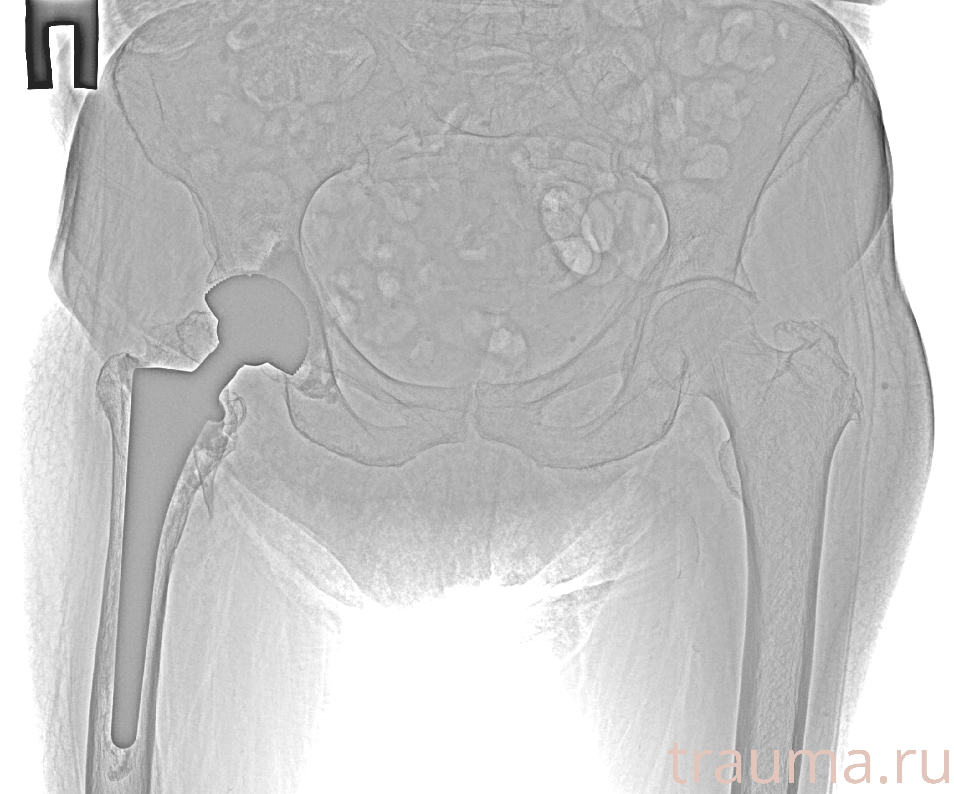 Рентген на дому: по вашему адресу приезжает врач-рентгенолог, травматолог-ортопед с мобильным рентгеновским аппаратом, проводит диагностику травмы или заболевания, делает необходимые рентгенограммы, дает рекомендации по дальнейшему лечению. Получить качественные снимки в домашних условиях возможно благодаря уникальной методике, разработанной МосРентген Центром для института  Склифосовского