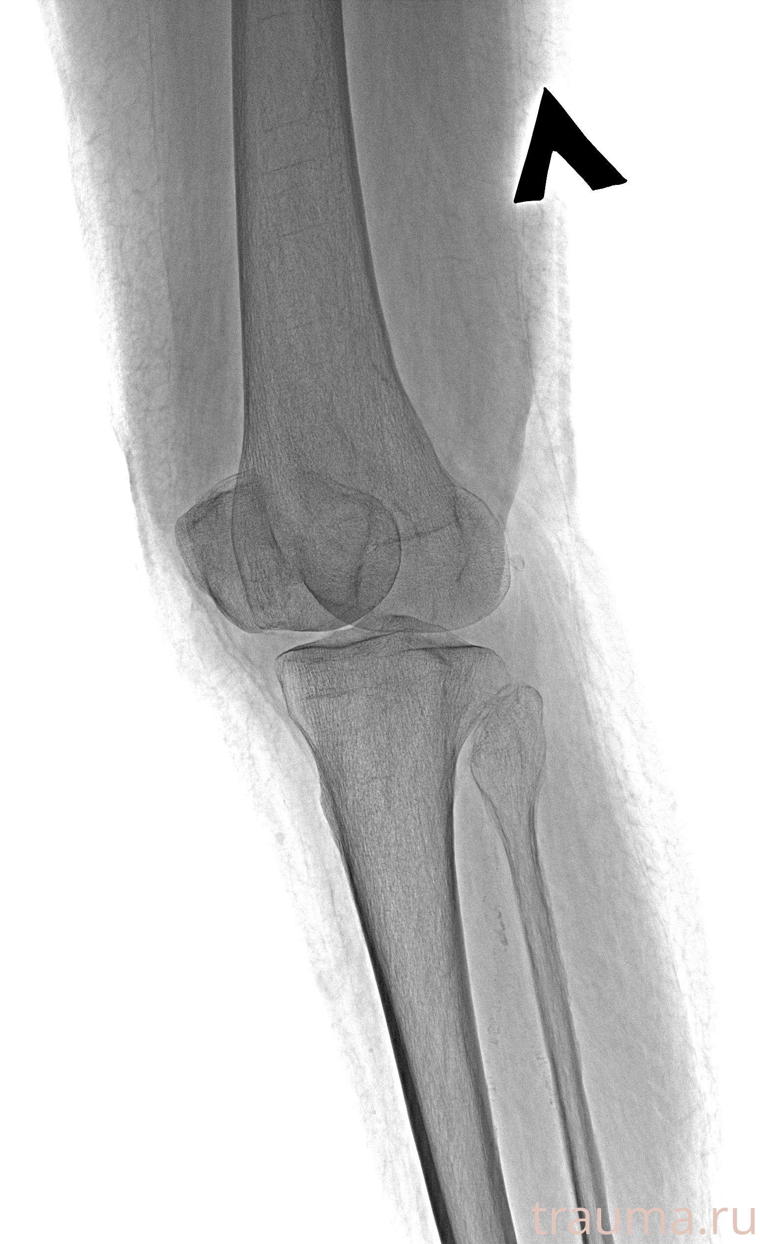 Рентген на дому: по вашему адресу приезжает врач-рентгенолог, травматолог-ортопед с мобильным рентгеновским аппаратом, проводит диагностику травмы или заболевания, делает необходимые рентгенограммы, дает рекомендации по дальнейшему лечению. Получить качественные снимки в домашних условиях возможно благодаря уникальной методике, разработанной МосРентген Центром для института  Склифосовского