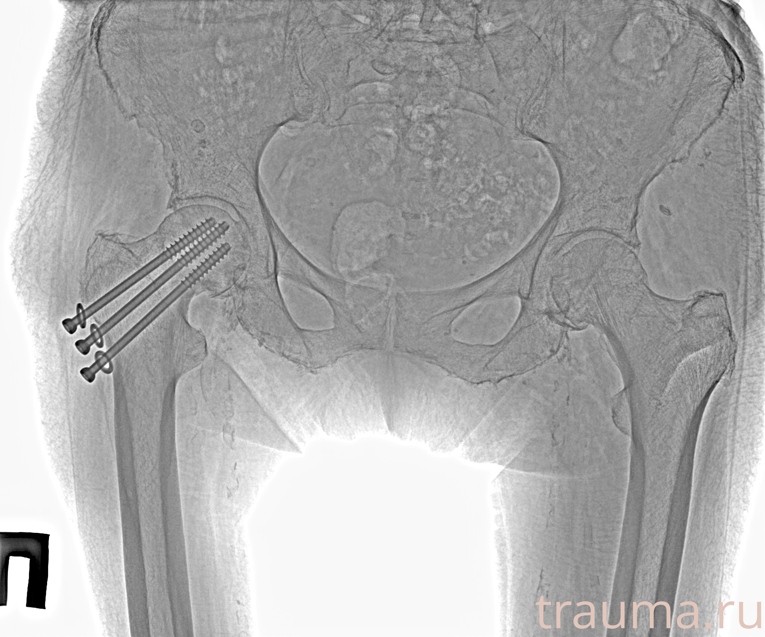 Рентген на дому: по вашему адресу приезжает врач-рентгенолог, травматолог-ортопед с мобильным рентгеновским аппаратом, проводит диагностику травмы или заболевания, делает необходимые рентгенограммы, дает рекомендации по дальнейшему лечению. Получить качественные снимки в домашних условиях возможно благодаря уникальной методике, разработанной МосРентген Центром для института  Склифосовского