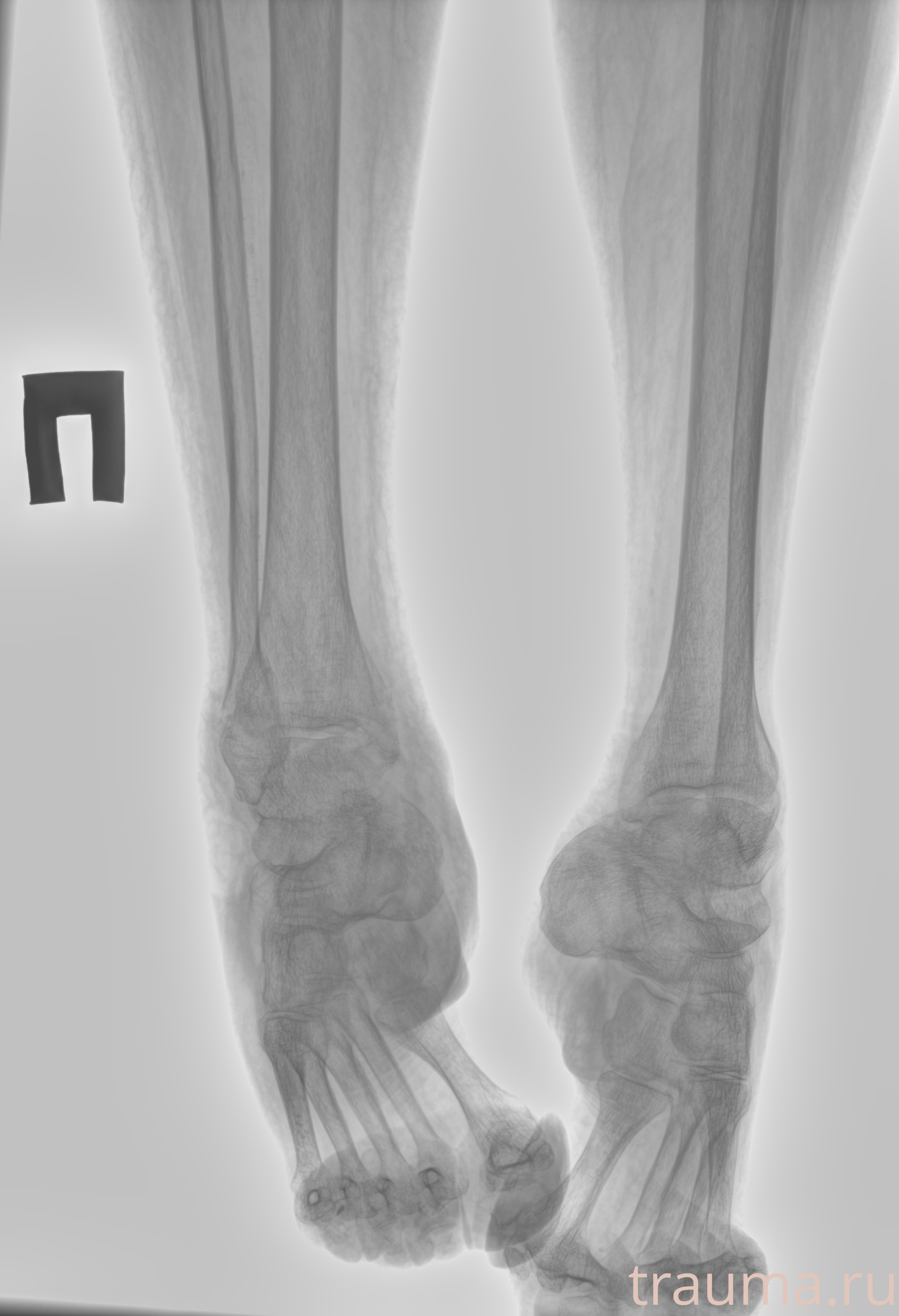 Рентген на дому: по вашему адресу приезжает врач-рентгенолог, травматолог-ортопед с мобильным рентгеновским аппаратом, проводит диагностику травмы или заболевания, делает необходимые рентгенограммы, дает рекомендации по дальнейшему лечению. Получить качественные снимки в домашних условиях возможно благодаря уникальной методике, разработанной МосРентген Центром для института  Склифосовского