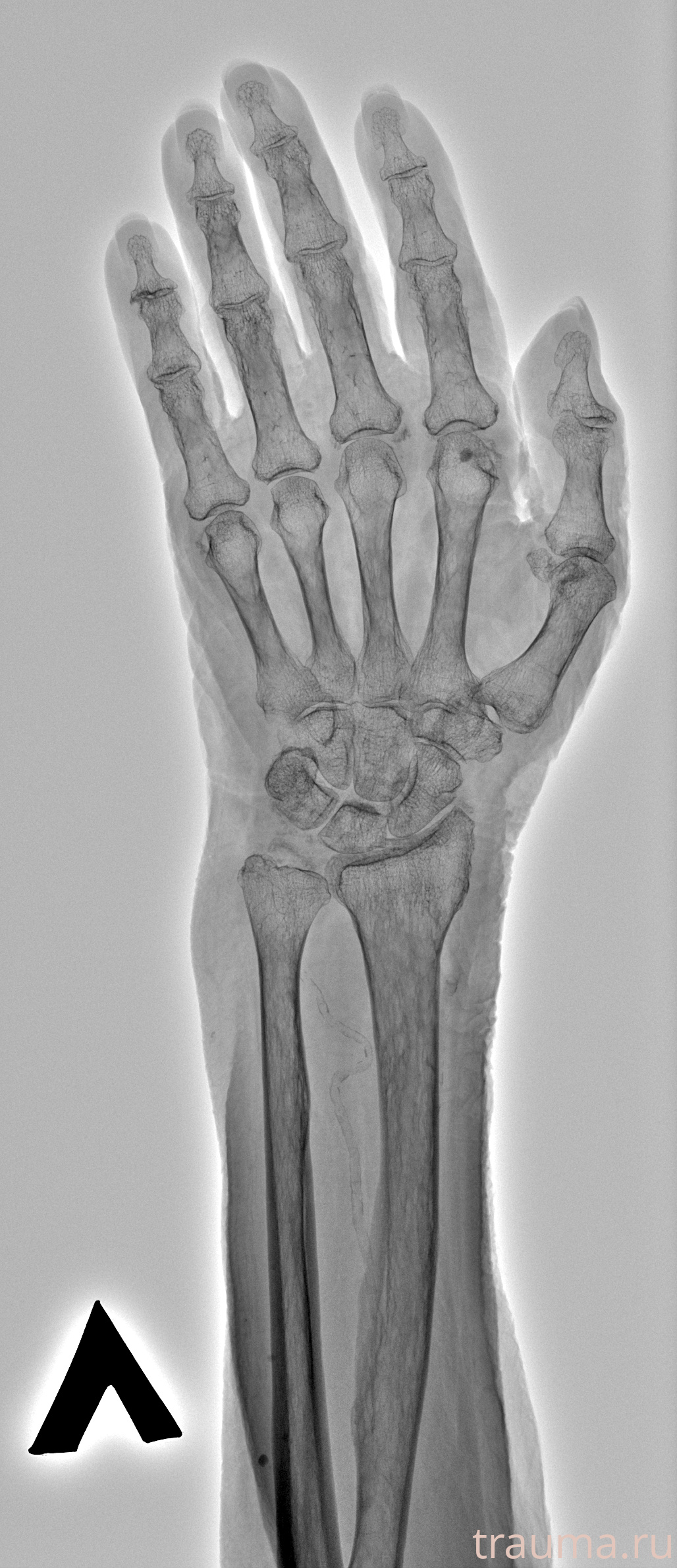 Рентген на дому: по вашему адресу приезжает врач-рентгенолог, травматолог-ортопед с мобильным рентгеновским аппаратом, проводит диагностику травмы или заболевания, делает необходимые рентгенограммы, дает рекомендации по дальнейшему лечению. Получить качественные снимки в домашних условиях возможно благодаря уникальной методике, разработанной МосРентген Центром для института  Склифосовского