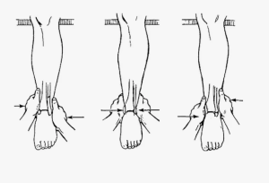 Алгоритм принятия решения о выборе метода лечения повреждений голеностопа на амбулаторном этапе