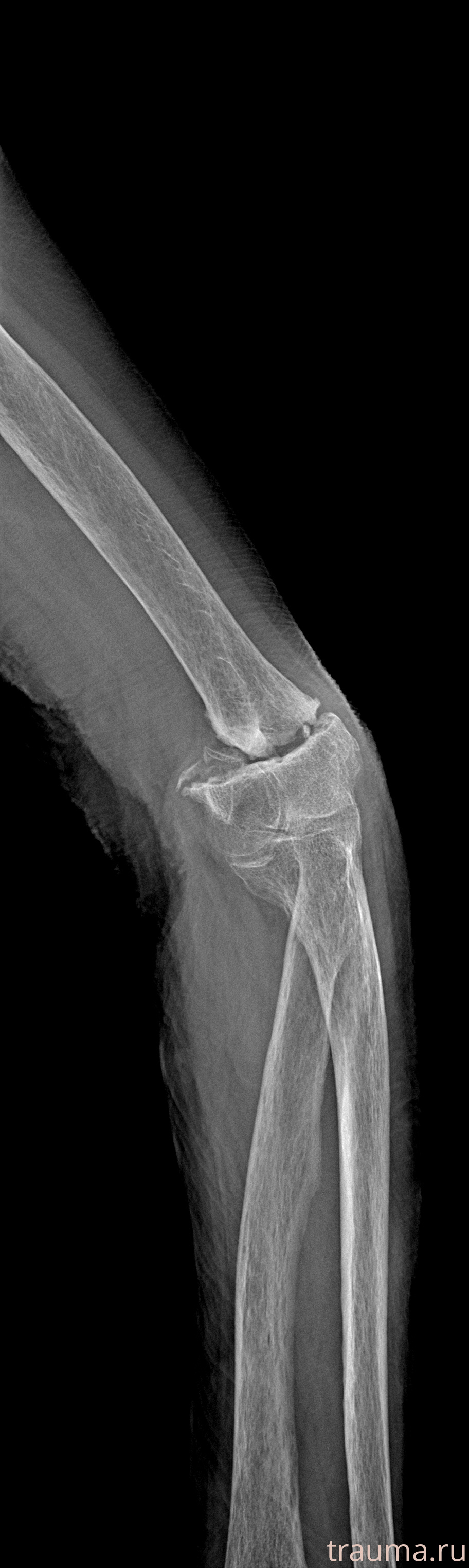 Рентген на дому: по вашему адресу приезжает врач-рентгенолог, травматолог-ортопед с мобильным рентгеновским аппаратом, проводит диагностику травмы или заболевания, делает необходимые рентгенограммы, дает рекомендации по дальнейшему лечению. Получить качественные снимки в домашних условиях возможно благодаря уникальной методике, разработанной МосРентген Центром для института  Склифосовского