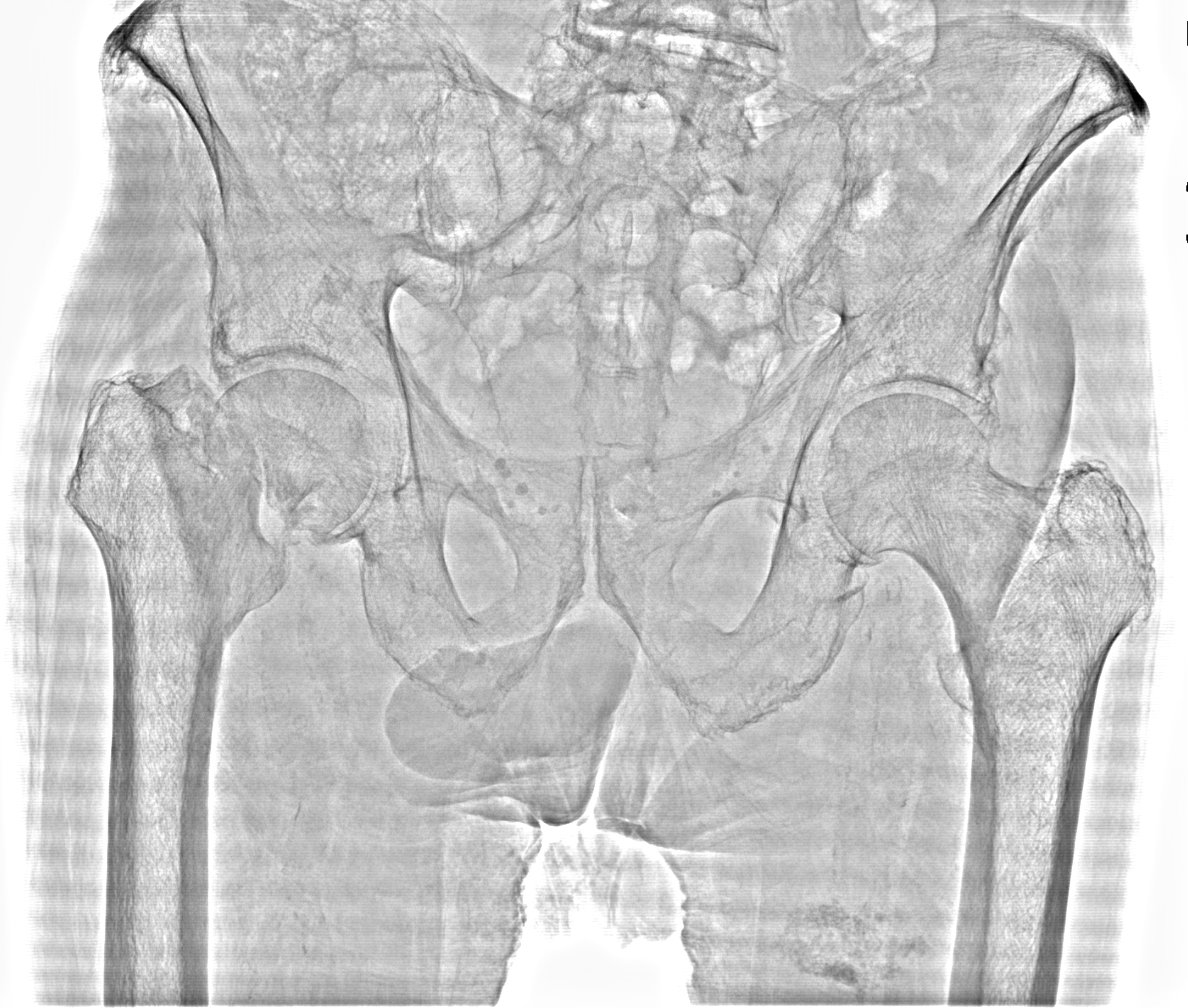 Рентген на дому: по вашему адресу приезжает врач-рентгенолог, травматолог-ортопед с мобильным рентгеновским аппаратом, проводит диагностику травмы или заболевания, делает необходимые рентгенограммы, дает рекомендации по дальнейшему лечению. Получить качественные снимки в домашних условиях возможно благодаря уникальной методике, разработанной МосРентген Центром для института  Склифосовского