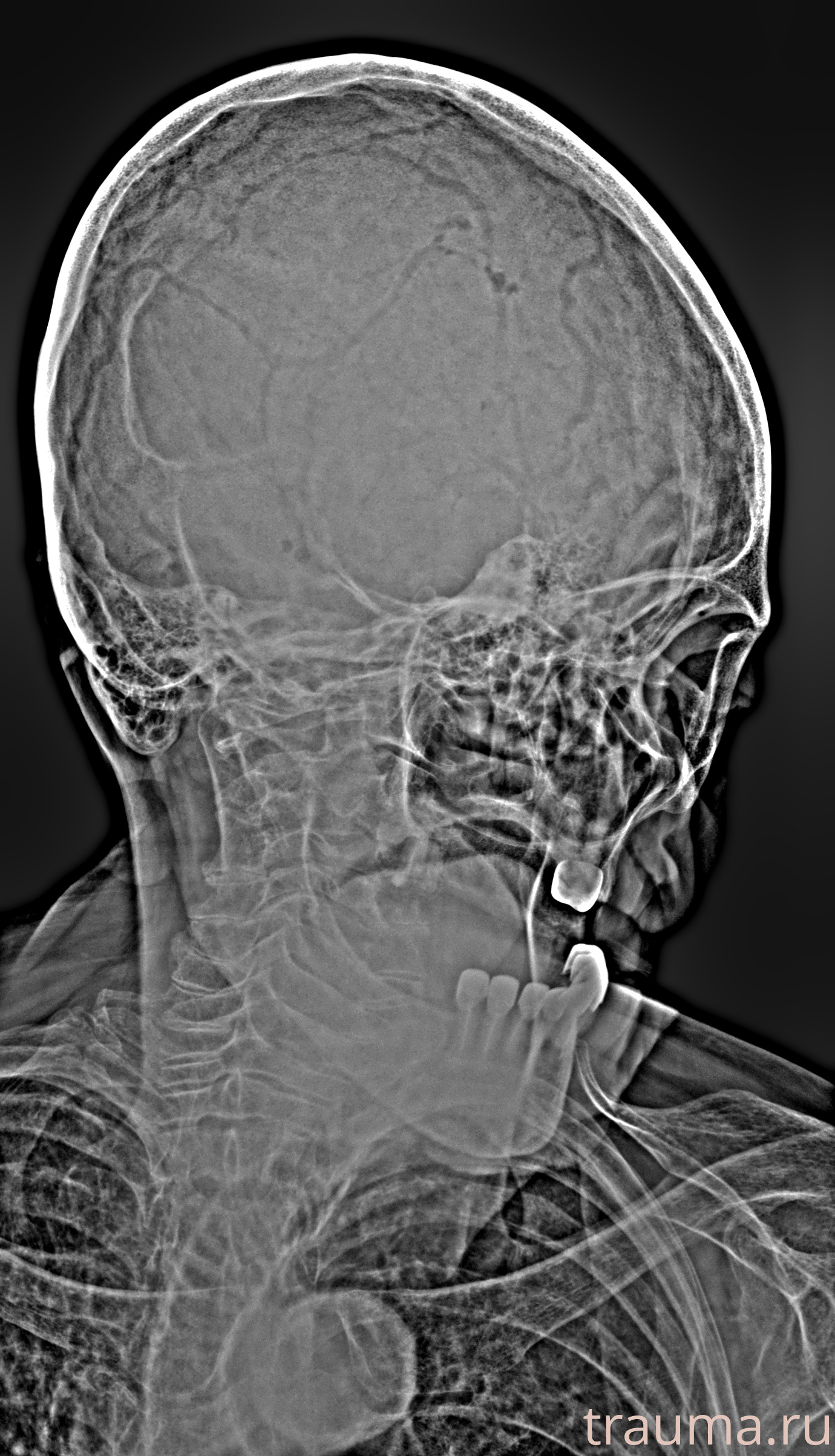 Рентген на дому: по вашему адресу приезжает врач-рентгенолог, травматолог-ортопед с мобильным рентгеновским аппаратом, проводит диагностику травмы или заболевания, делает необходимые рентгенограммы, дает рекомендации по дальнейшему лечению. Получить качественные снимки в домашних условиях возможно благодаря уникальной методике, разработанной МосРентген Центром для института  Склифосовского
