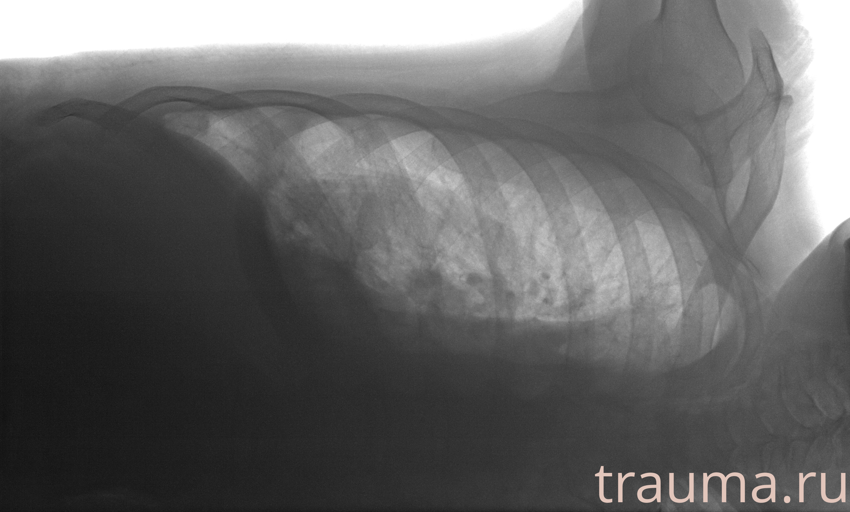 Рентген на дому: по вашему адресу приезжает врач-рентгенолог, травматолог-ортопед с мобильным рентгеновским аппаратом, проводит диагностику травмы или заболевания, делает необходимые рентгенограммы, дает рекомендации по дальнейшему лечению. Получить качественные снимки в домашних условиях возможно благодаря уникальной методике, разработанной МосРентген Центром для института  Склифосовского