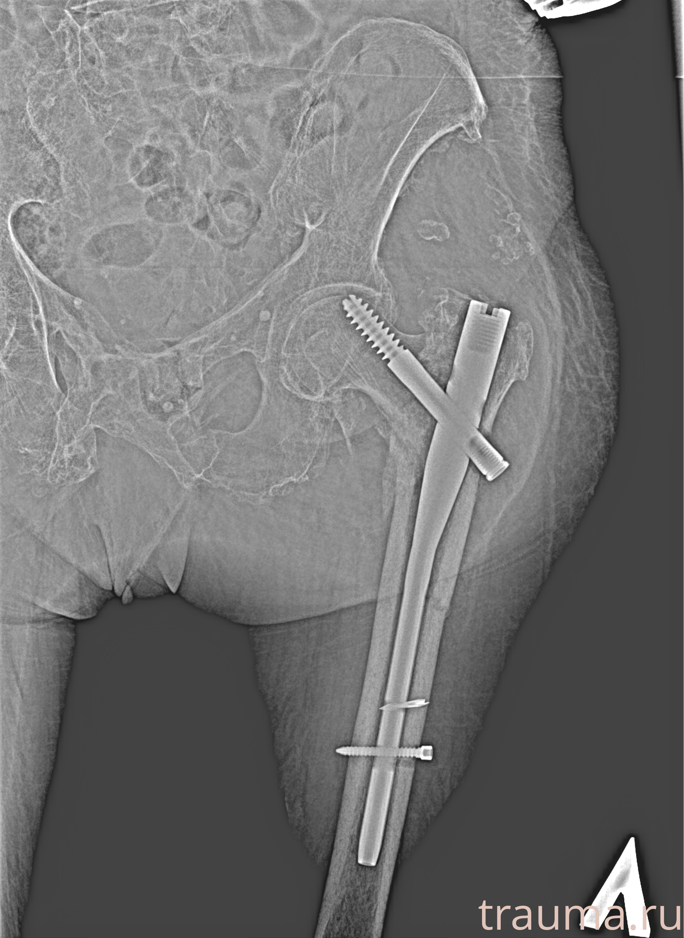Рентген на дому: по вашему адресу приезжает врач-рентгенолог, травматолог-ортопед с мобильным рентгеновским аппаратом, проводит диагностику травмы или заболевания, делает необходимые рентгенограммы, дает рекомендации по дальнейшему лечению. Получить качественные снимки в домашних условиях возможно благодаря уникальной методике, разработанной МосРентген Центром для института  Склифосовского