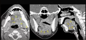 Эффективность МРТ и МСКТ в определении глубины инвазии плоскоклеточной карциномы языка