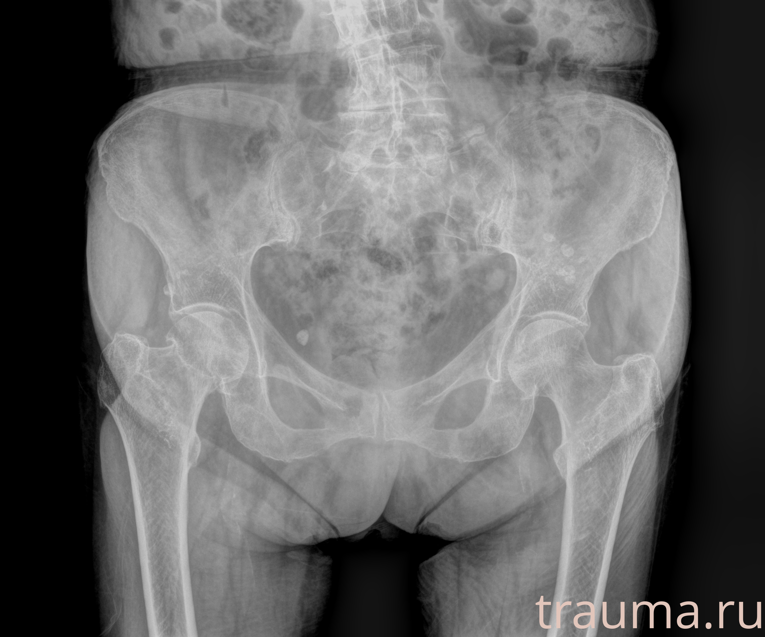 Рентген на дому: по вашему адресу приезжает врач-рентгенолог, травматолог-ортопед с мобильным рентгеновским аппаратом, проводит диагностику травмы или заболевания, делает необходимые рентгенограммы, дает рекомендации по дальнейшему лечению. Получить качественные снимки в домашних условиях возможно благодаря уникальной методике, разработанной МосРентген Центром для института  Склифосовского