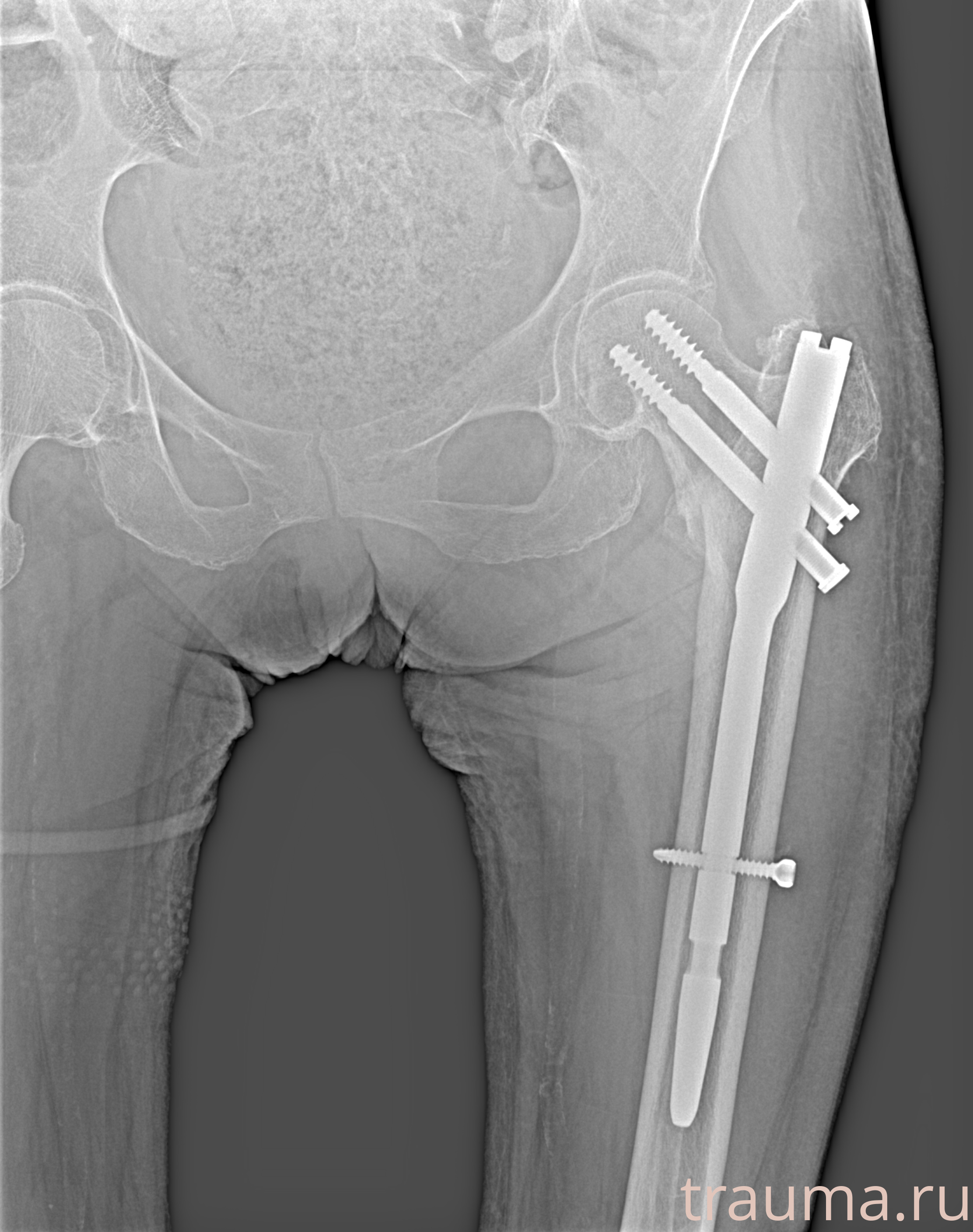 Рентген на дому: по вашему адресу приезжает врач-рентгенолог, травматолог-ортопед с мобильным рентгеновским аппаратом, проводит диагностику травмы или заболевания, делает необходимые рентгенограммы, дает рекомендации по дальнейшему лечению. Получить качественные снимки в домашних условиях возможно благодаря уникальной методике, разработанной МосРентген Центром для института  Склифосовского