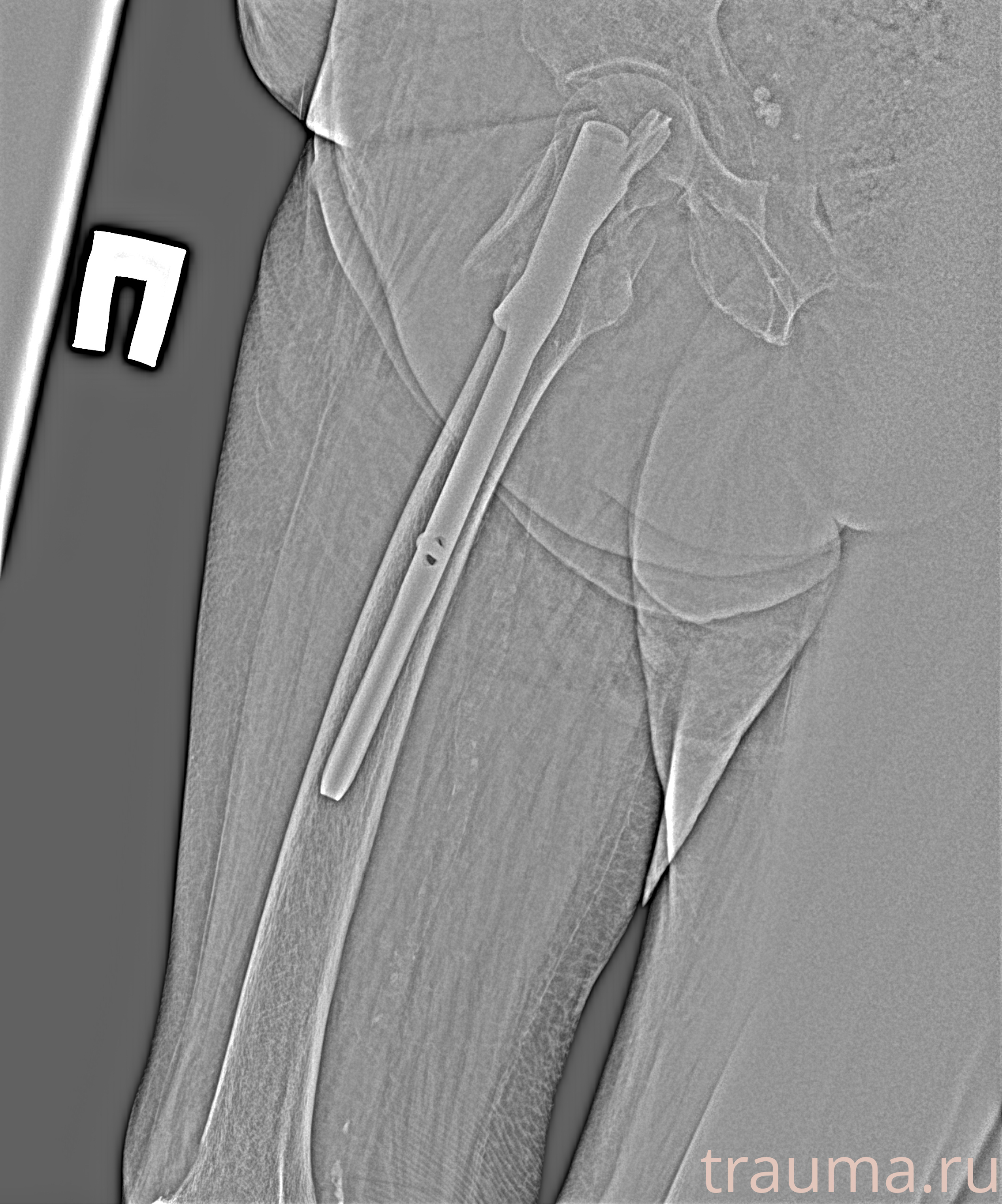 Рентген на дому: по вашему адресу приезжает врач-рентгенолог, травматолог-ортопед с мобильным рентгеновским аппаратом, проводит диагностику травмы или заболевания, делает необходимые рентгенограммы, дает рекомендации по дальнейшему лечению. Получить качественные снимки в домашних условиях возможно благодаря уникальной методике, разработанной МосРентген Центром для института  Склифосовского