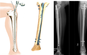 Чрескостный остеосинтез внутри- и околосуставных переломов
костей коленного сустава
