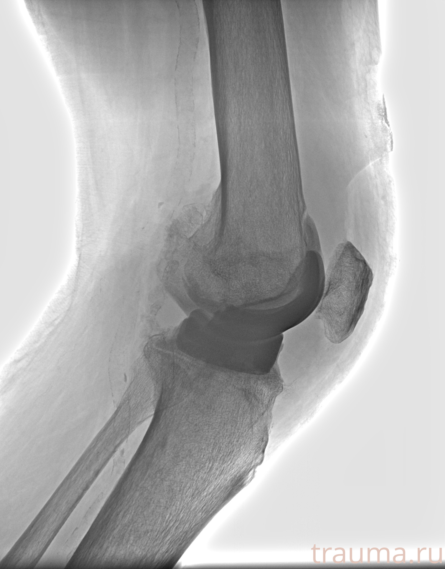 Рентген на дому: по вашему адресу приезжает врач-рентгенолог, травматолог-ортопед с мобильным рентгеновским аппаратом, проводит диагностику травмы или заболевания, делает необходимые рентгенограммы, дает рекомендации по дальнейшему лечению. Получить качественные снимки в домашних условиях возможно благодаря уникальной методике, разработанной МосРентген Центром для института  Склифосовского