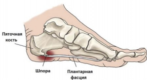Кальцифицирующим тендинитплантарной связки («Пяточная шпора») Кальцифицирующим тендинитплантарной связки («Пяточная шпора»)