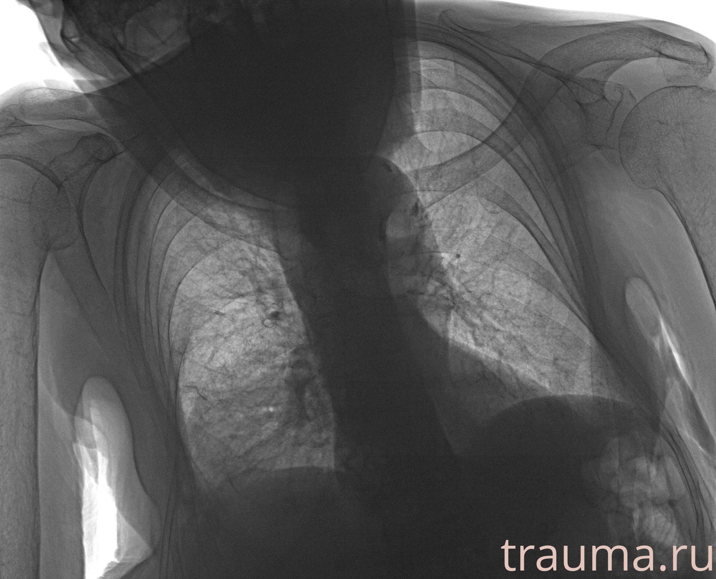 Рентген на дому: по вашему адресу приезжает врач-рентгенолог, травматолог-ортопед с мобильным рентгеновским аппаратом, проводит диагностику травмы или заболевания, делает необходимые рентгенограммы, дает рекомендации по дальнейшему лечению. Получить качественные снимки в домашних условиях возможно благодаря уникальной методике, разработанной МосРентген Центром для института  Склифосовского