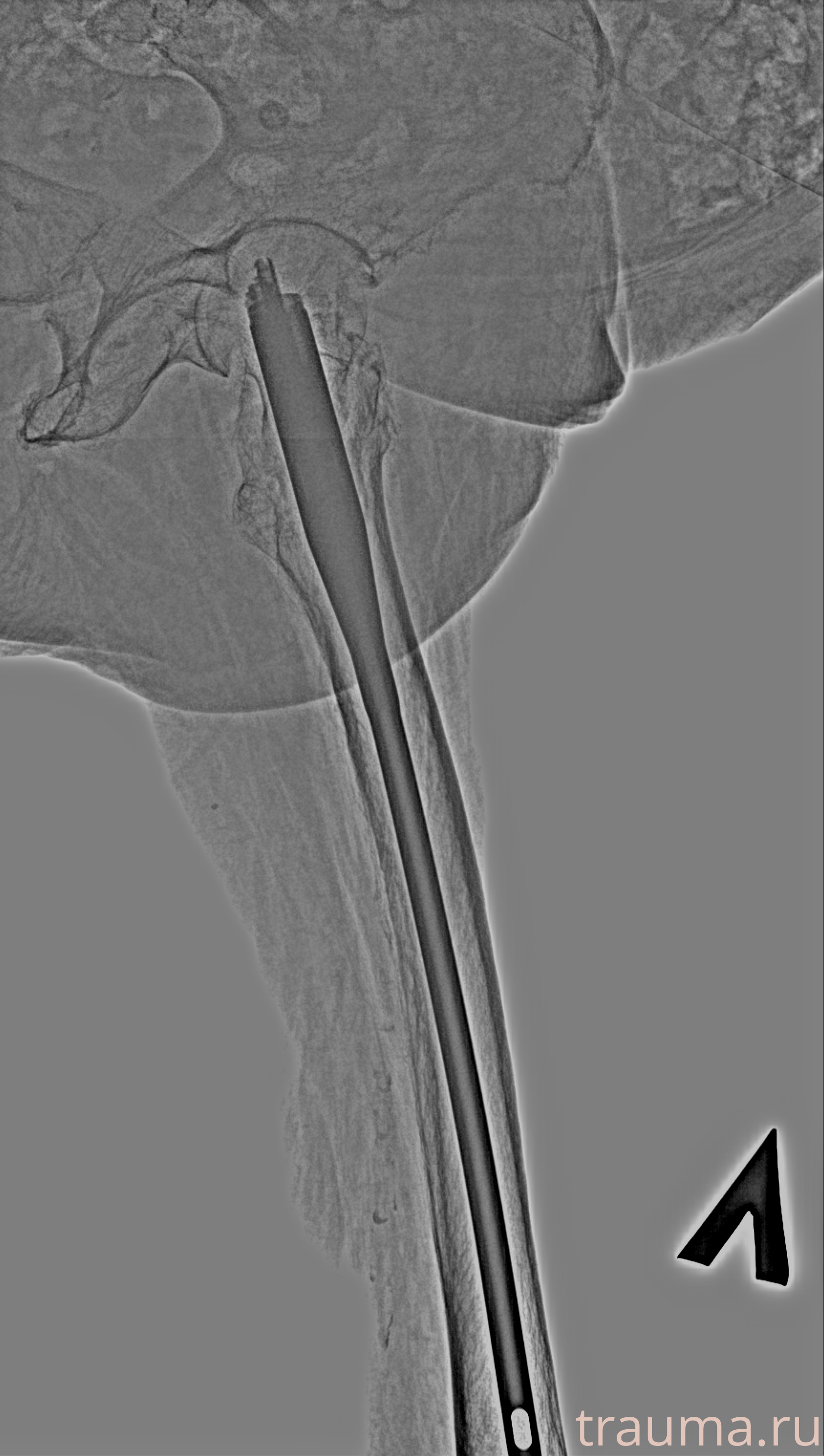 Рентген на дому: по вашему адресу приезжает врач-рентгенолог, травматолог-ортопед с мобильным рентгеновским аппаратом, проводит диагностику травмы или заболевания, делает необходимые рентгенограммы, дает рекомендации по дальнейшему лечению. Получить качественные снимки в домашних условиях возможно благодаря уникальной методике, разработанной МосРентген Центром для института  Склифосовского