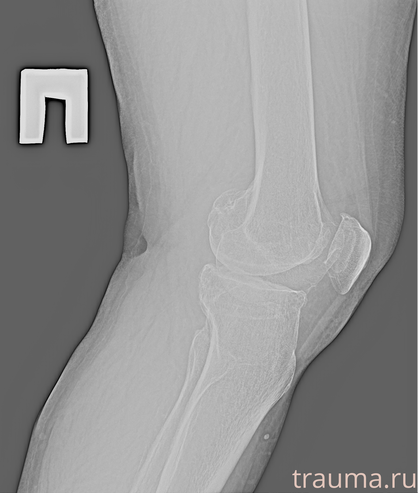Рентген на дому: по вашему адресу приезжает врач-рентгенолог, травматолог-ортопед с мобильным рентгеновским аппаратом, проводит диагностику травмы или заболевания, делает необходимые рентгенограммы, дает рекомендации по дальнейшему лечению. Получить качественные снимки в домашних условиях возможно благодаря уникальной методике, разработанной МосРентген Центром для института  Склифосовского