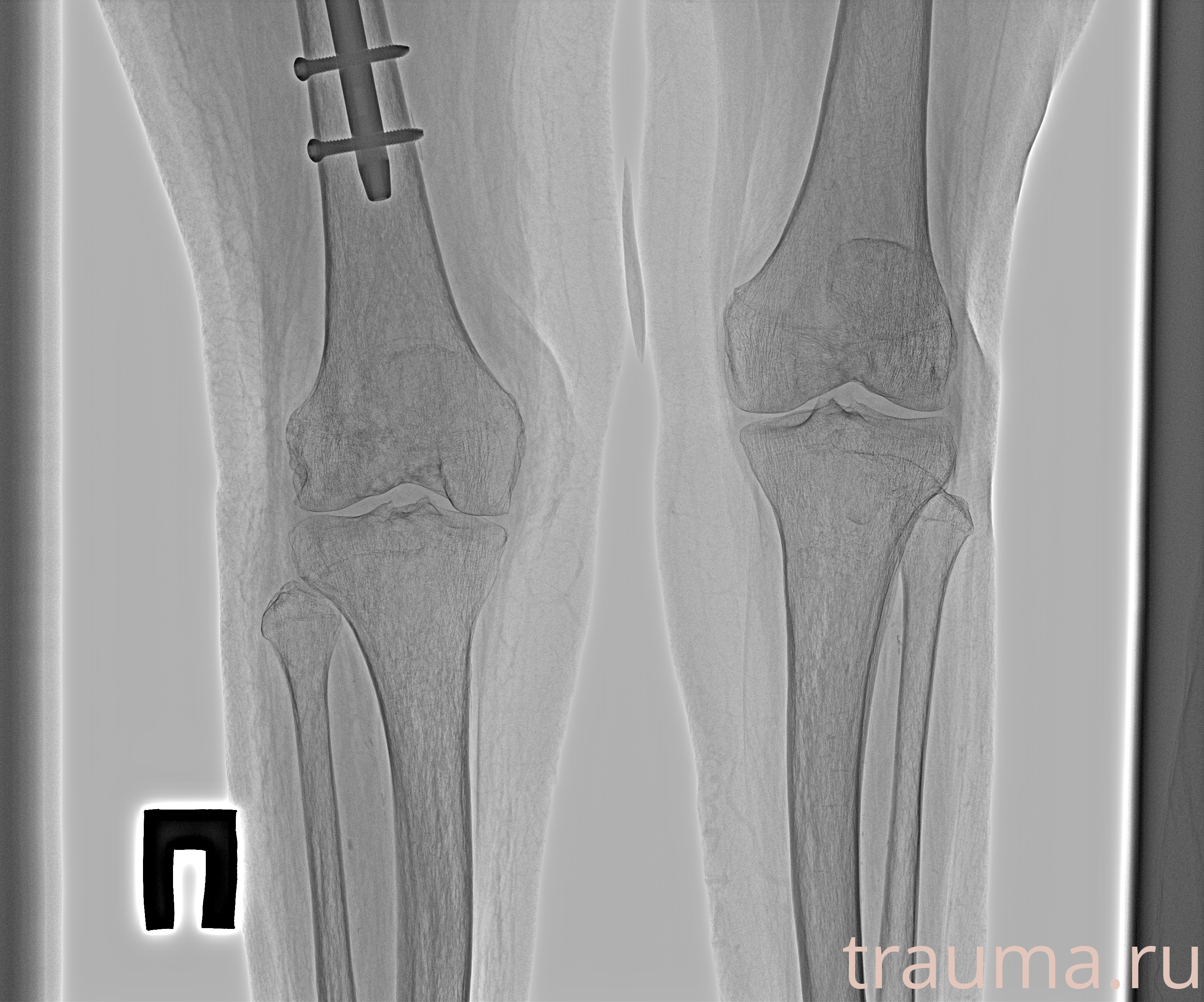 Рентген на дому: по вашему адресу приезжает врач-рентгенолог, травматолог-ортопед с мобильным рентгеновским аппаратом, проводит диагностику травмы или заболевания, делает необходимые рентгенограммы, дает рекомендации по дальнейшему лечению. Получить качественные снимки в домашних условиях возможно благодаря уникальной методике, разработанной МосРентген Центром для института  Склифосовского