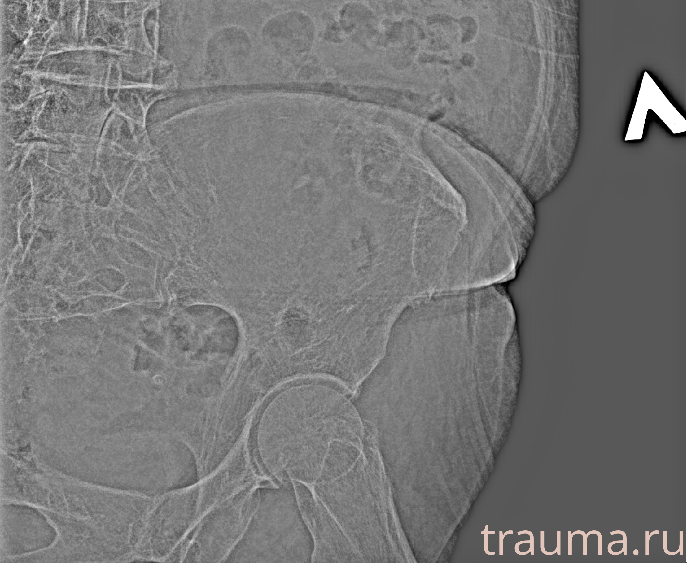 Рентген на дому: по вашему адресу приезжает врач-рентгенолог, травматолог-ортопед с мобильным рентгеновским аппаратом, проводит диагностику травмы или заболевания, делает необходимые рентгенограммы, дает рекомендации по дальнейшему лечению. Получить качественные снимки в домашних условиях возможно благодаря уникальной методике, разработанной МосРентген Центром для института  Склифосовского