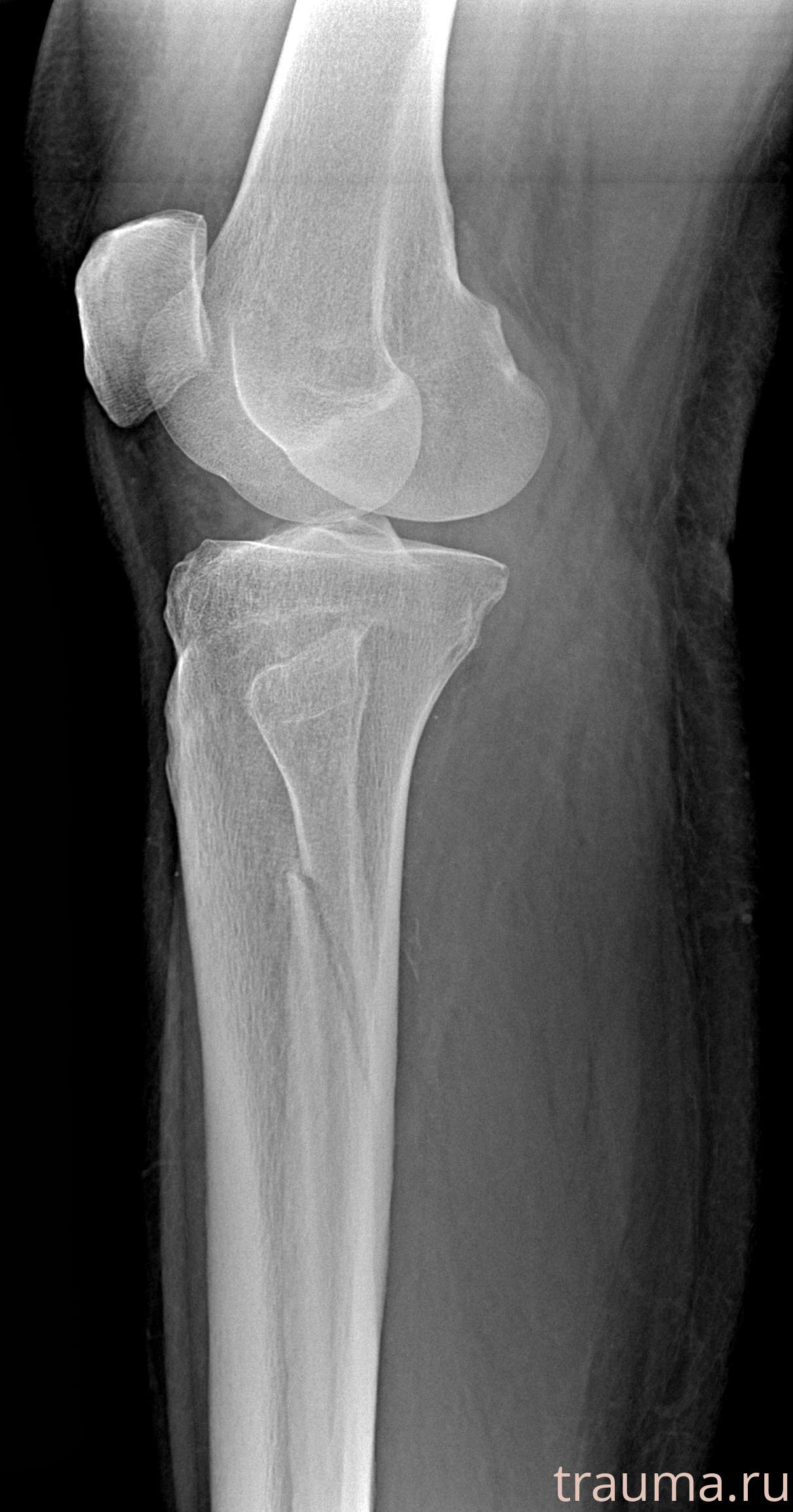 Рентген на дому: по вашему адресу приезжает врач-рентгенолог, травматолог-ортопед с мобильным рентгеновским аппаратом, проводит диагностику травмы или заболевания, делает необходимые рентгенограммы, дает рекомендации по дальнейшему лечению. Получить качественные снимки в домашних условиях возможно благодаря уникальной методике, разработанной МосРентген Центром для института  Склифосовского
