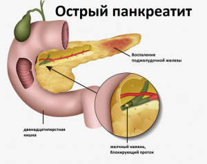 Постманипуляционный панкреотит:актуальность прблемы, сложности диагностики и нерешенные проблемы Постманипуляционный панкреотит:актуальность прблемы, сложности диагностики и нерешенные проблемы