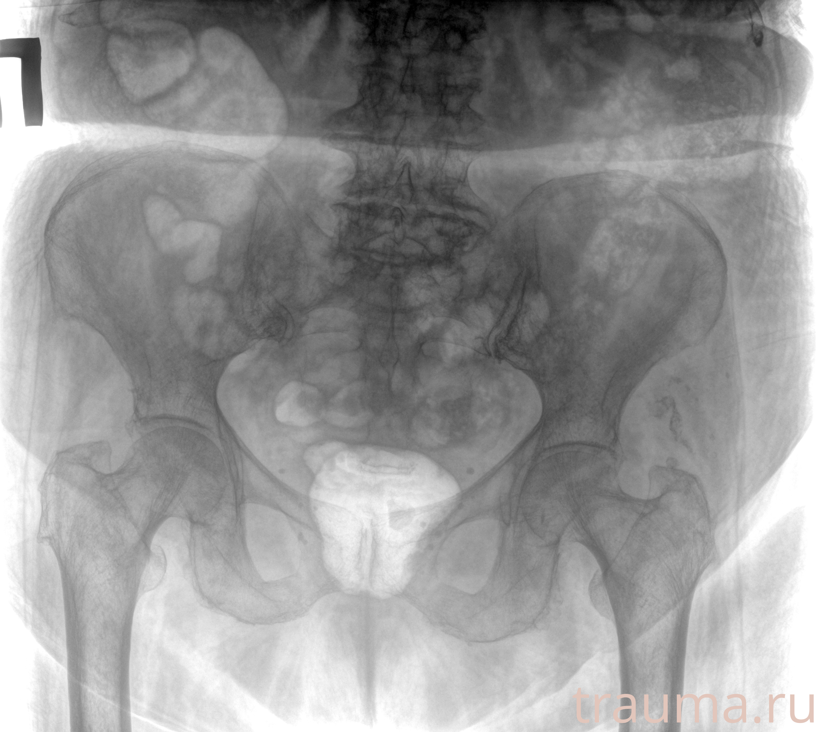 Рентген на дому: по вашему адресу приезжает врач-рентгенолог, травматолог-ортопед с мобильным рентгеновским аппаратом, проводит диагностику травмы или заболевания, делает необходимые рентгенограммы, дает рекомендации по дальнейшему лечению. Получить качественные снимки в домашних условиях возможно благодаря уникальной методике, разработанной МосРентген Центром для института  Склифосовского