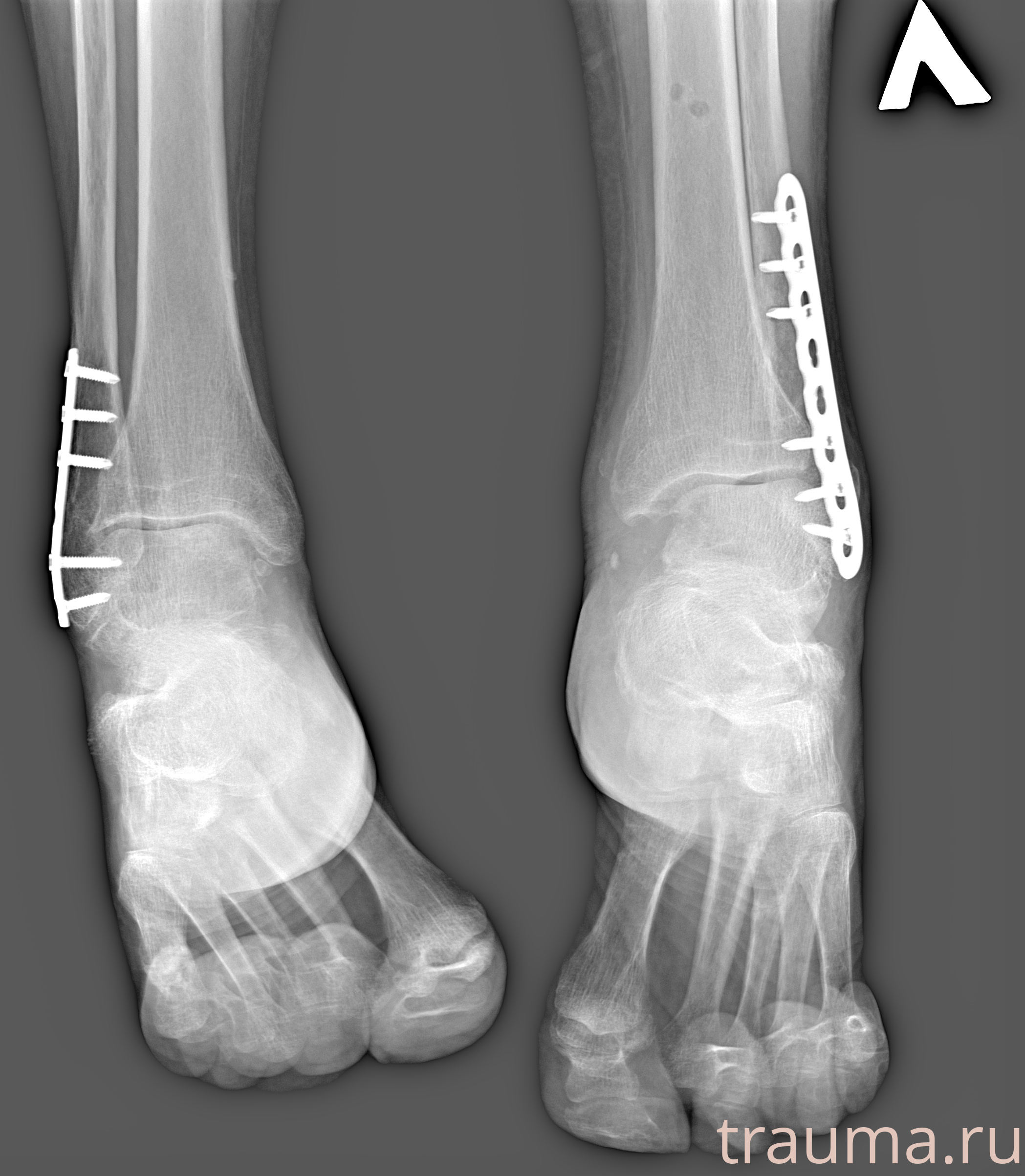 Рентген на дому: по вашему адресу приезжает врач-рентгенолог, травматолог-ортопед с мобильным рентгеновским аппаратом, проводит диагностику травмы или заболевания, делает необходимые рентгенограммы, дает рекомендации по дальнейшему лечению. Получить качественные снимки в домашних условиях возможно благодаря уникальной методике, разработанной МосРентген Центром для института  Склифосовского