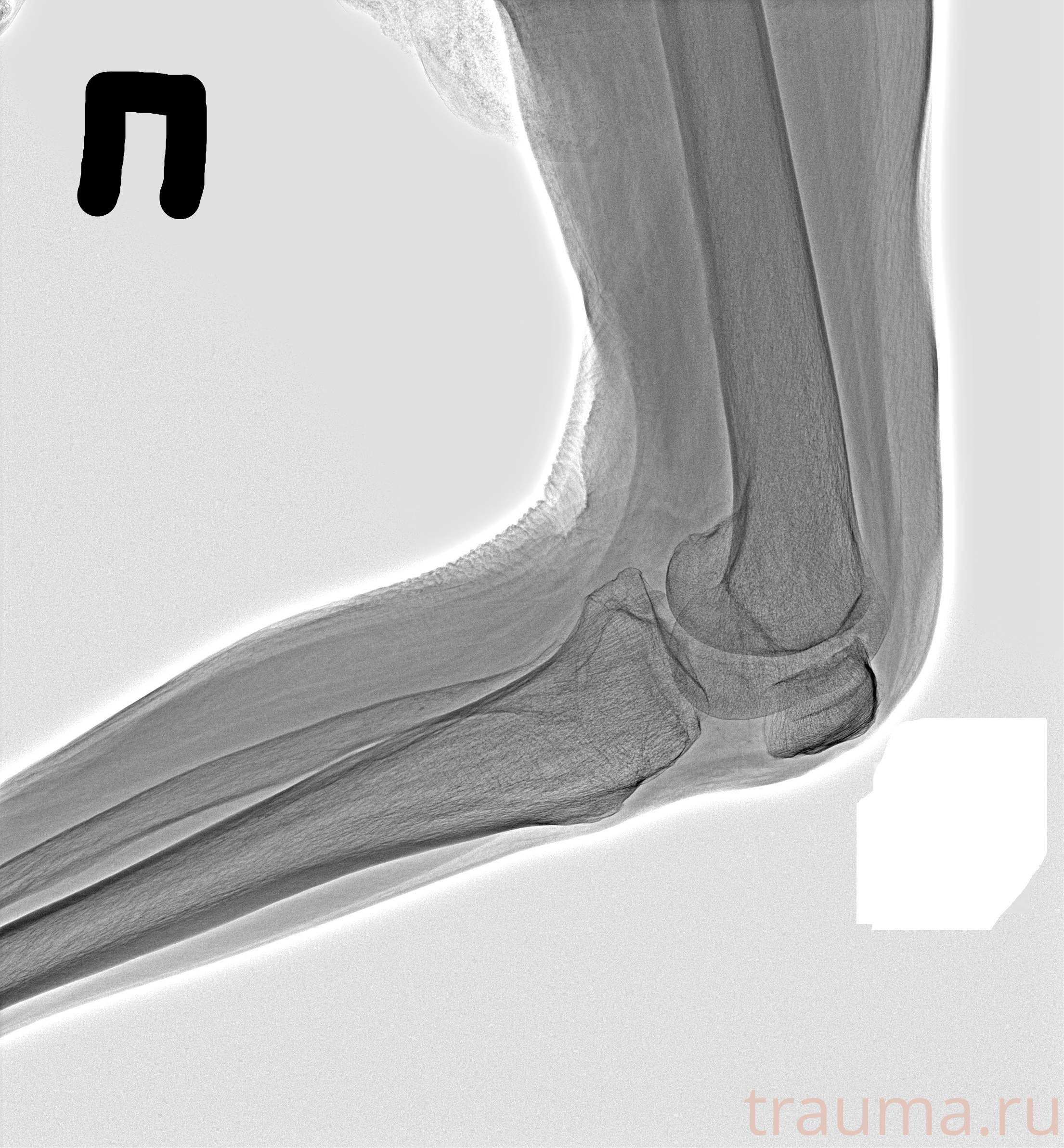 Рентген на дому: по вашему адресу приезжает врач-рентгенолог, травматолог-ортопед с мобильным рентгеновским аппаратом, проводит диагностику травмы или заболевания, делает необходимые рентгенограммы, дает рекомендации по дальнейшему лечению. Получить качественные снимки в домашних условиях возможно благодаря уникальной методике, разработанной МосРентген Центром для института  Склифосовского