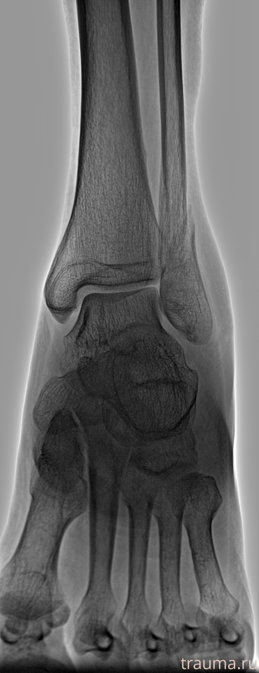 Рентген на дому: по вашему адресу приезжает врач-рентгенолог, травматолог-ортопед с мобильным рентгеновским аппаратом, проводит диагностику травмы или заболевания, делает необходимые рентгенограммы, дает рекомендации по дальнейшему лечению. Получить качественные снимки в домашних условиях возможно благодаря уникальной методике, разработанной МосРентген Центром для института  Склифосовского