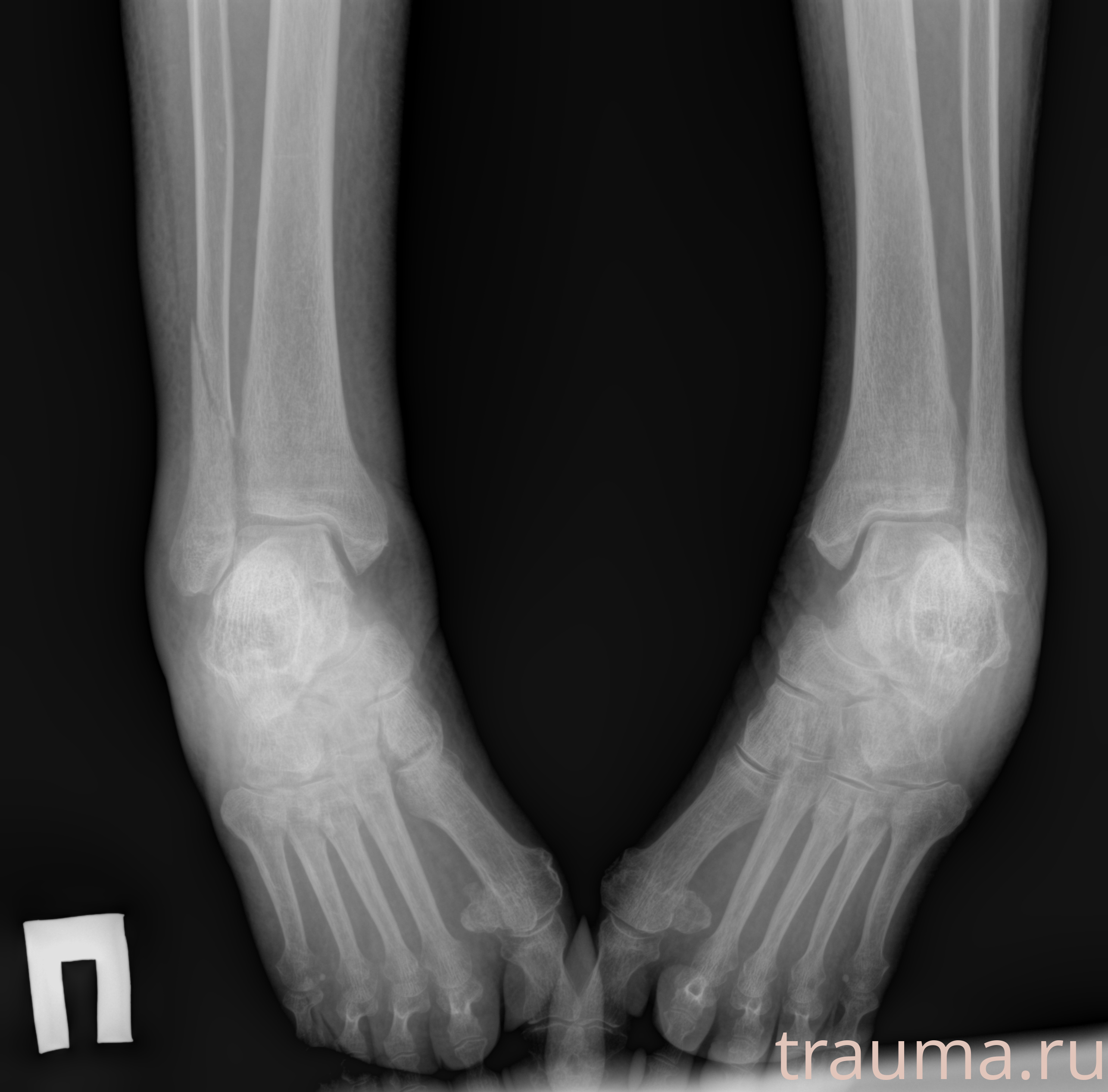 Рентген на дому: по вашему адресу приезжает врач-рентгенолог, травматолог-ортопед с мобильным рентгеновским аппаратом, проводит диагностику травмы или заболевания, делает необходимые рентгенограммы, дает рекомендации по дальнейшему лечению. Получить качественные снимки в домашних условиях возможно благодаря уникальной методике, разработанной МосРентген Центром для института  Склифосовского