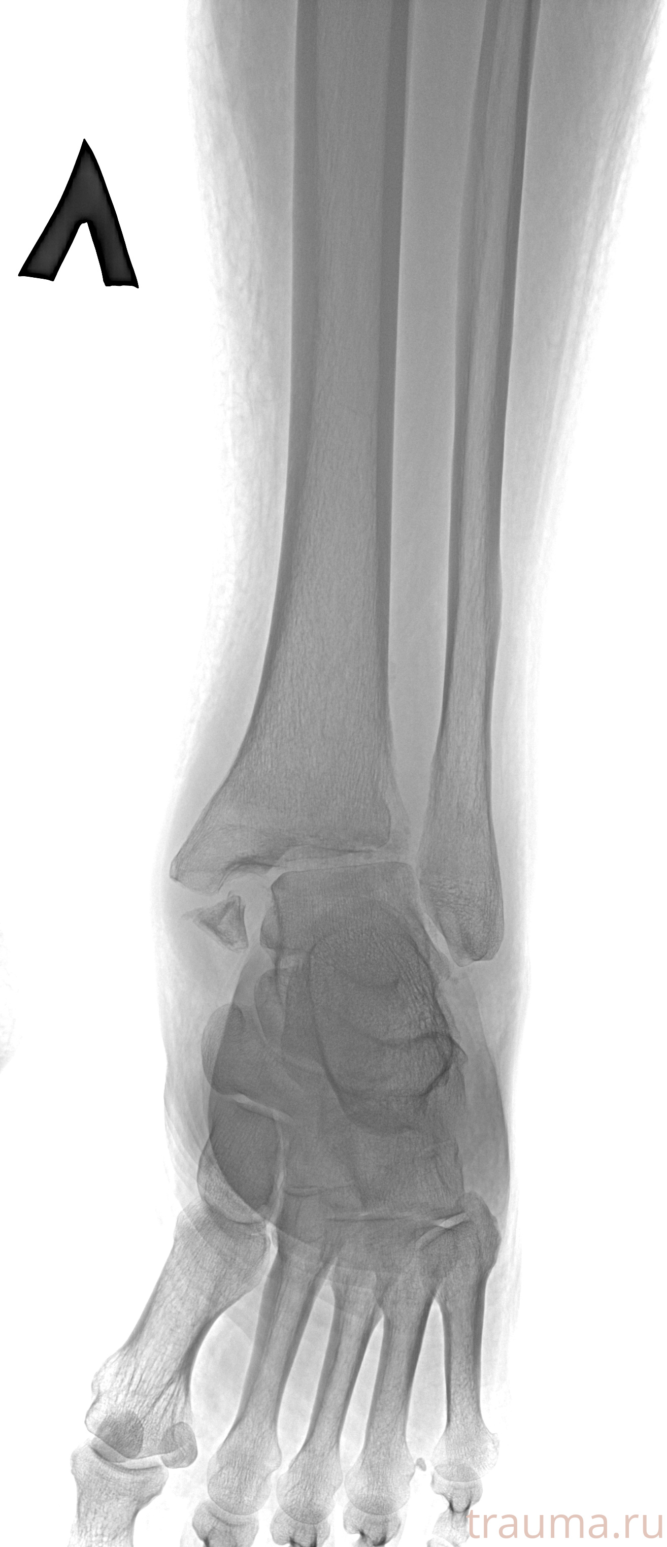 Рентген на дому: по вашему адресу приезжает врач-рентгенолог, травматолог-ортопед с мобильным рентгеновским аппаратом, проводит диагностику травмы или заболевания, делает необходимые рентгенограммы, дает рекомендации по дальнейшему лечению. Получить качественные снимки в домашних условиях возможно благодаря уникальной методике, разработанной МосРентген Центром для института  Склифосовского