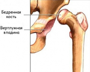 Оптимизация хирургического лечения детей с врожденным подвывихом бедра на основании прогнозирования развития тазобедренного сустава Оптимизация хирургического лечения детей с врожденным подвывихом бедра на основании прогнозирования развития тазобедренного сустава