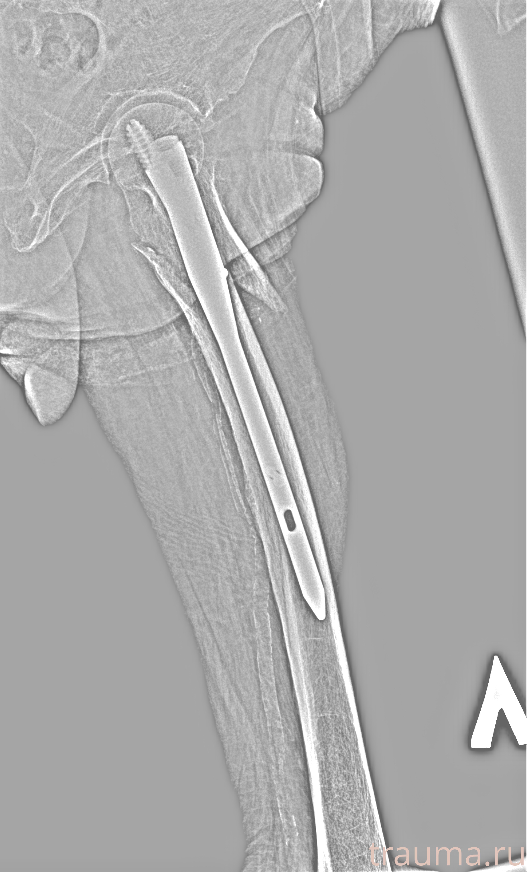 Рентген на дому: по вашему адресу приезжает врач-рентгенолог, травматолог-ортопед с мобильным рентгеновским аппаратом, проводит диагностику травмы или заболевания, делает необходимые рентгенограммы, дает рекомендации по дальнейшему лечению. Получить качественные снимки в домашних условиях возможно благодаря уникальной методике, разработанной МосРентген Центром для института  Склифосовского