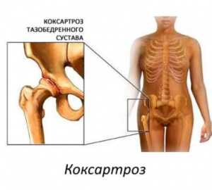 Гематологические особенности у больных ревматоидным артритом при эндопротезировании тазобедренного сустава Гематологические особенности у больных ревматоидным артритом при эндопротезировании тазобедренного сустава