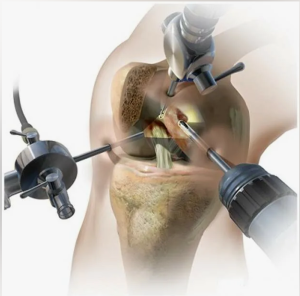 Собственный опыт применения поликапролактона при производстве  скаффолда мениска   коленного сустава