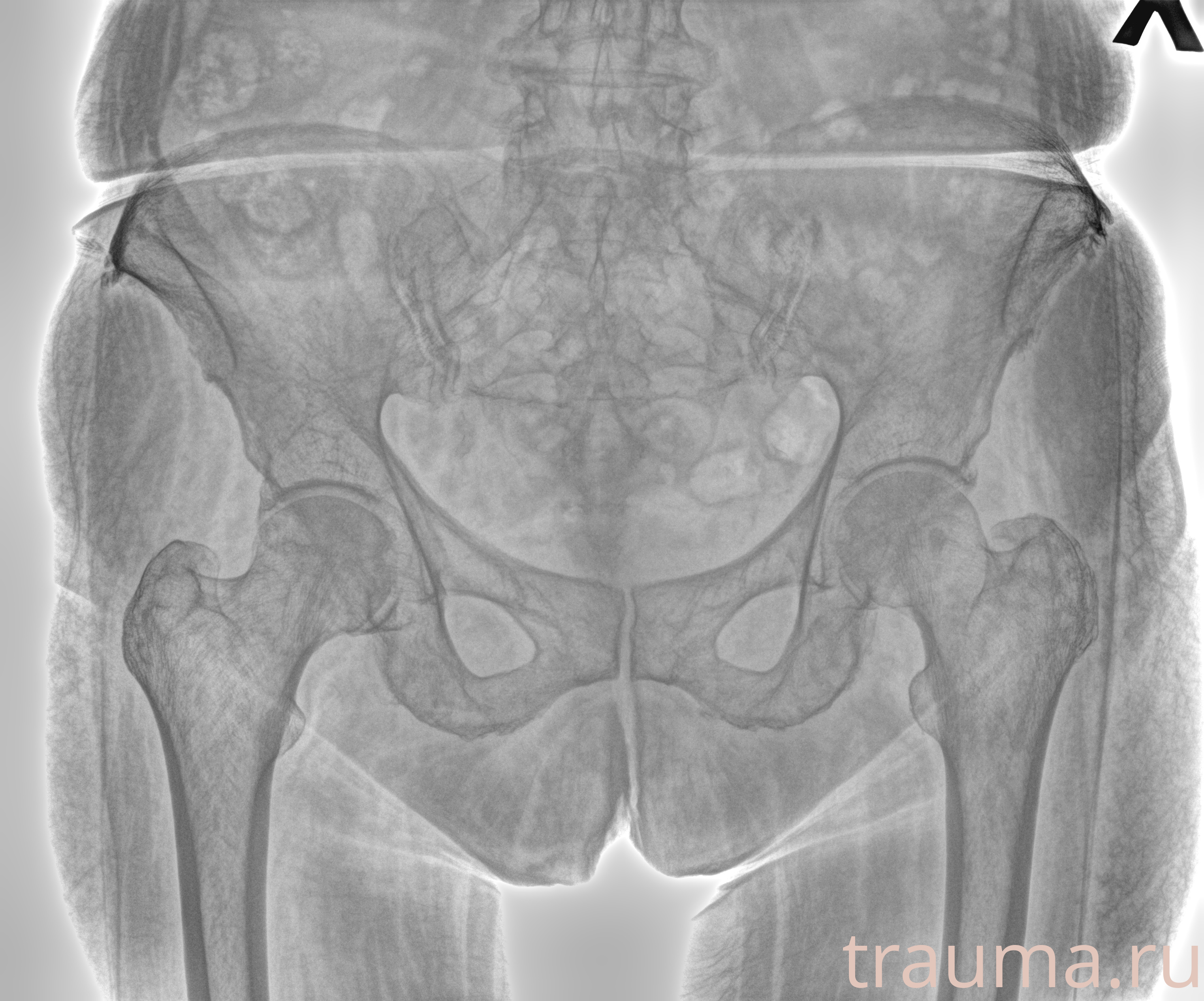 Рентген на дому: по вашему адресу приезжает врач-рентгенолог, травматолог-ортопед с мобильным рентгеновским аппаратом, проводит диагностику травмы или заболевания, делает необходимые рентгенограммы, дает рекомендации по дальнейшему лечению. Получить качественные снимки в домашних условиях возможно благодаря уникальной методике, разработанной МосРентген Центром для института  Склифосовского